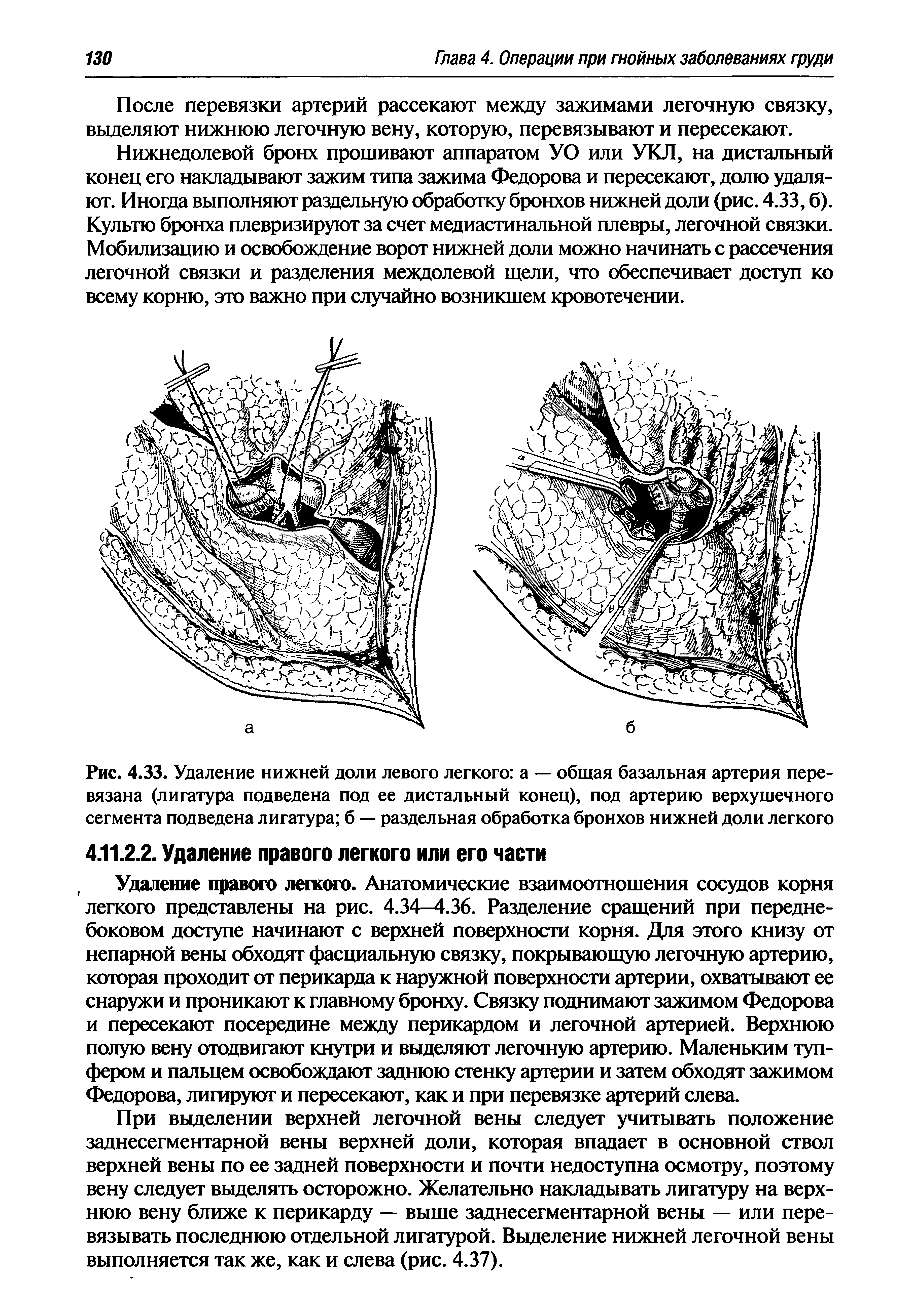 Рис. 4.33. Удаление нижней доли левого легкого а — общая базальная артерия перевязана (лигатура подведена под ее дистальный конец), под артерию верхушечного сегмента подведена лигатура б — раздельная обработка бронхов нижней доли легкого...