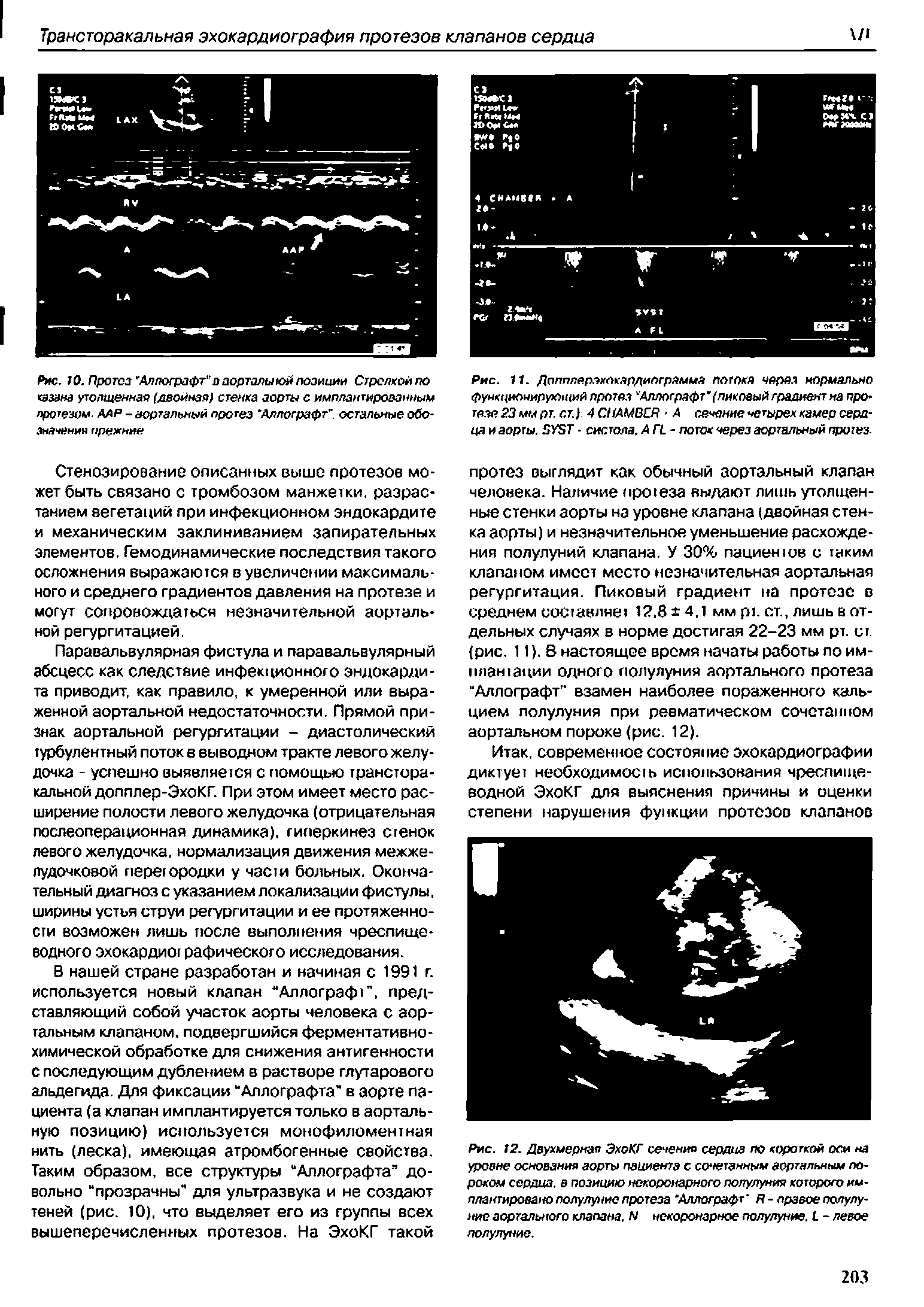 Рис. 11. Допплерэхпкардипграмма потока через нормально функционирующий протез Аллографт (пиковый градиент на про-тезе 23 мм рт. ст.) 4СНАМВСЯ А сечение четырех камер сердца и аорты. 2У5Т систола, АП- поток через аортальный пршез...
