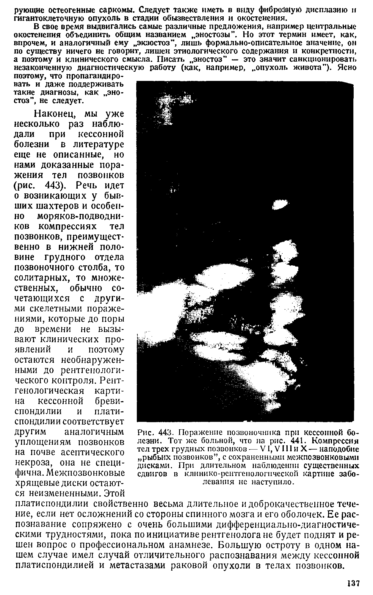 Рис. 443. Поражение позвоночника при кессонной болезни. Тот же больной, что на рис. 441. Компрессия тел трех грудных позвонков — VI, V111 и X — наподобие рыбьих позвонков , с сохраненными межпозвонковыми дисками. При длительном наблюдении существенных сдвигов в клинико-рентгенологической картине заболевания не наступило.