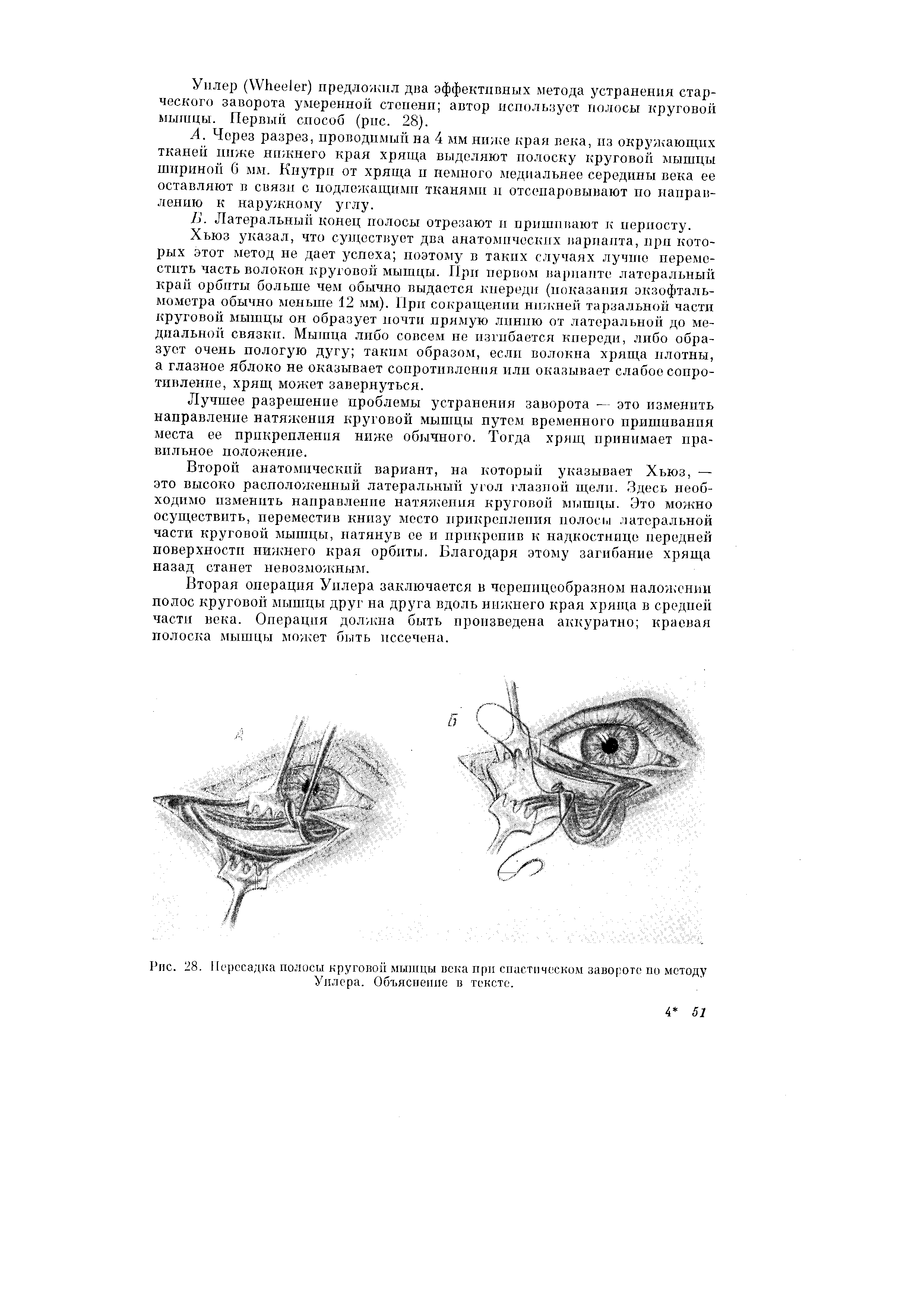 Рис. 28. Пересадка полосы круговой мышцы века при спастическом завороте по методу Уилера. Объяснение в тексте.