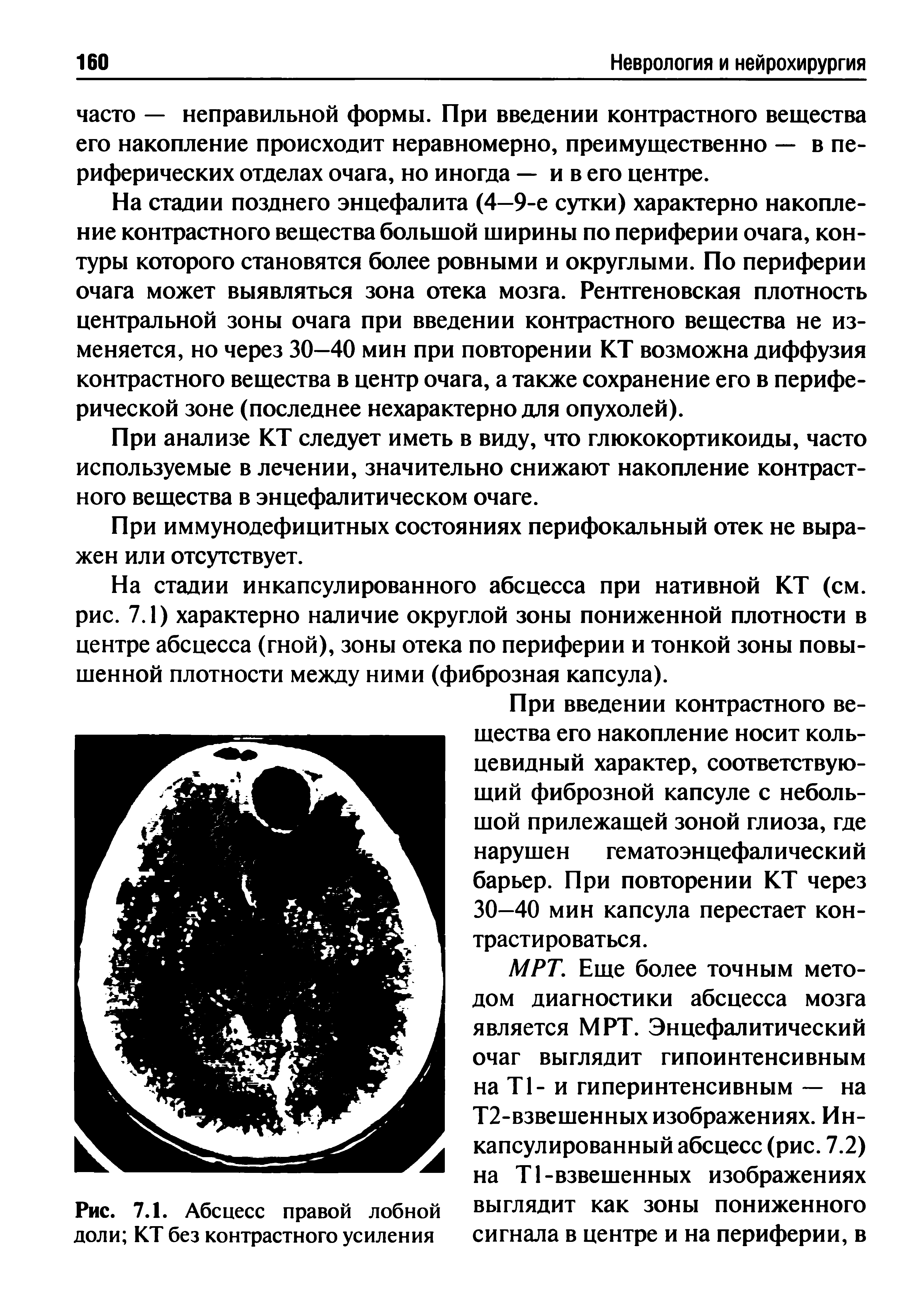 Рис. 7.1. Абсцесс правой лобной доли КТ без контрастного усиления...