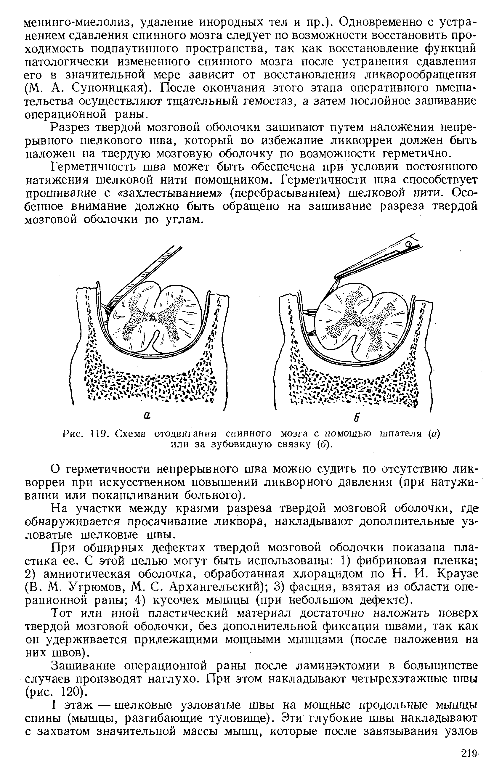 Рис. 119. Схема отодвигания спинного мозга с помощью шпателя (а) или за зубовидную связку (б).