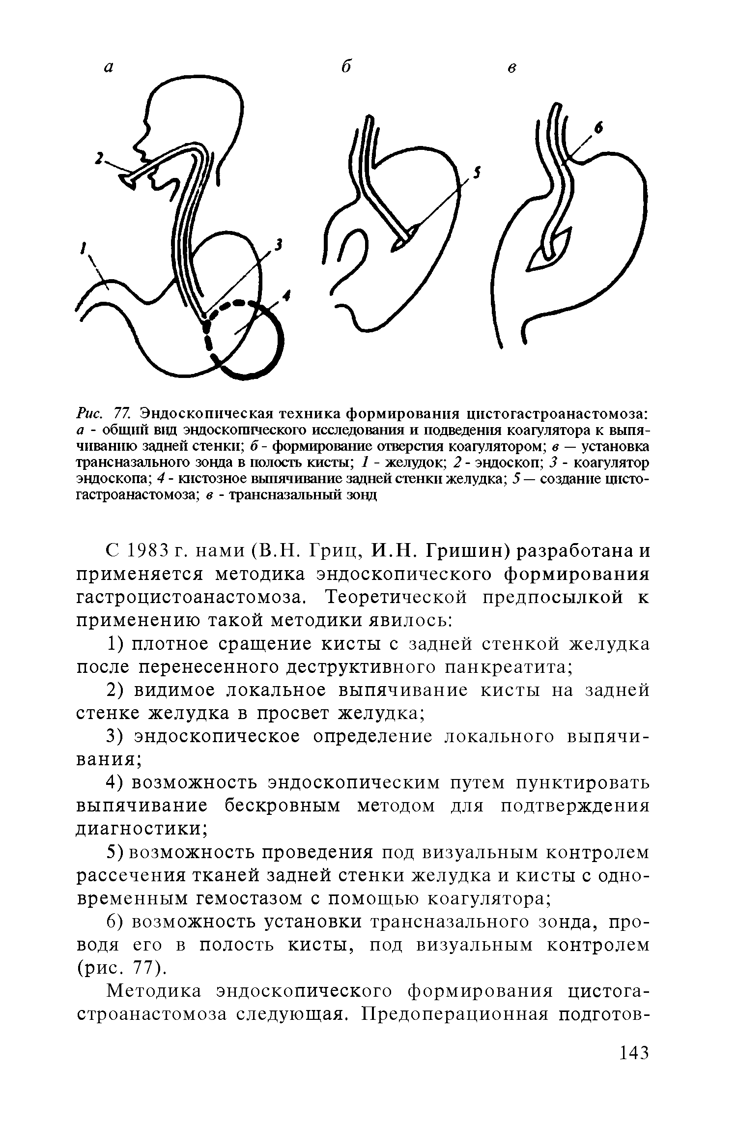 Рис. 77. Эндоскопическая техника формирования цистогастроанастомоза а - общий вид эндоскопического исследования и подведения коагулятора к выпячиванию задней стенки б - формирование отверстия коагулятором в — установка трансназального зонда в полость кисты 1 - желудок 2 - эндоскоп 3 - коагулятор эндоскопа 4 - кистозное выпячивание задней стенки желудка 5 — создание цистогастроанастомоза в - трансназальный зонд...