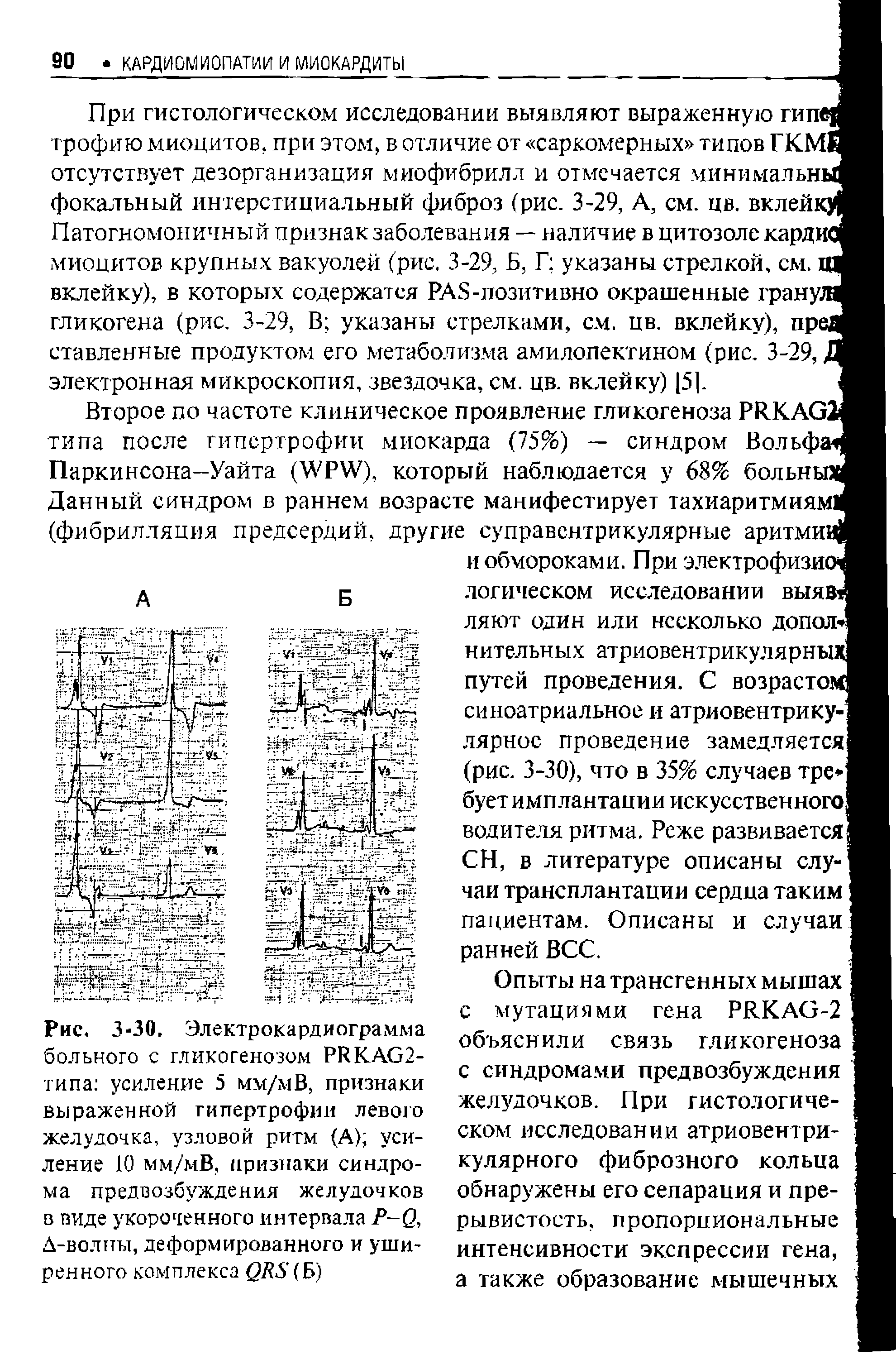 Рис. 3-30. Электрокардиограмма больного с гликогенозом РИКАО2-типа усиление 5 мм/мВ, признаки выраженной гипертрофии левого желудочка, узловой ритм (А) усиление 10 мм/мВ, признаки синдрома предвозбуждения желудочков в виде укороченного интервала Р 0, Д-волны, деформированного и уширенного комплекса (Б)...