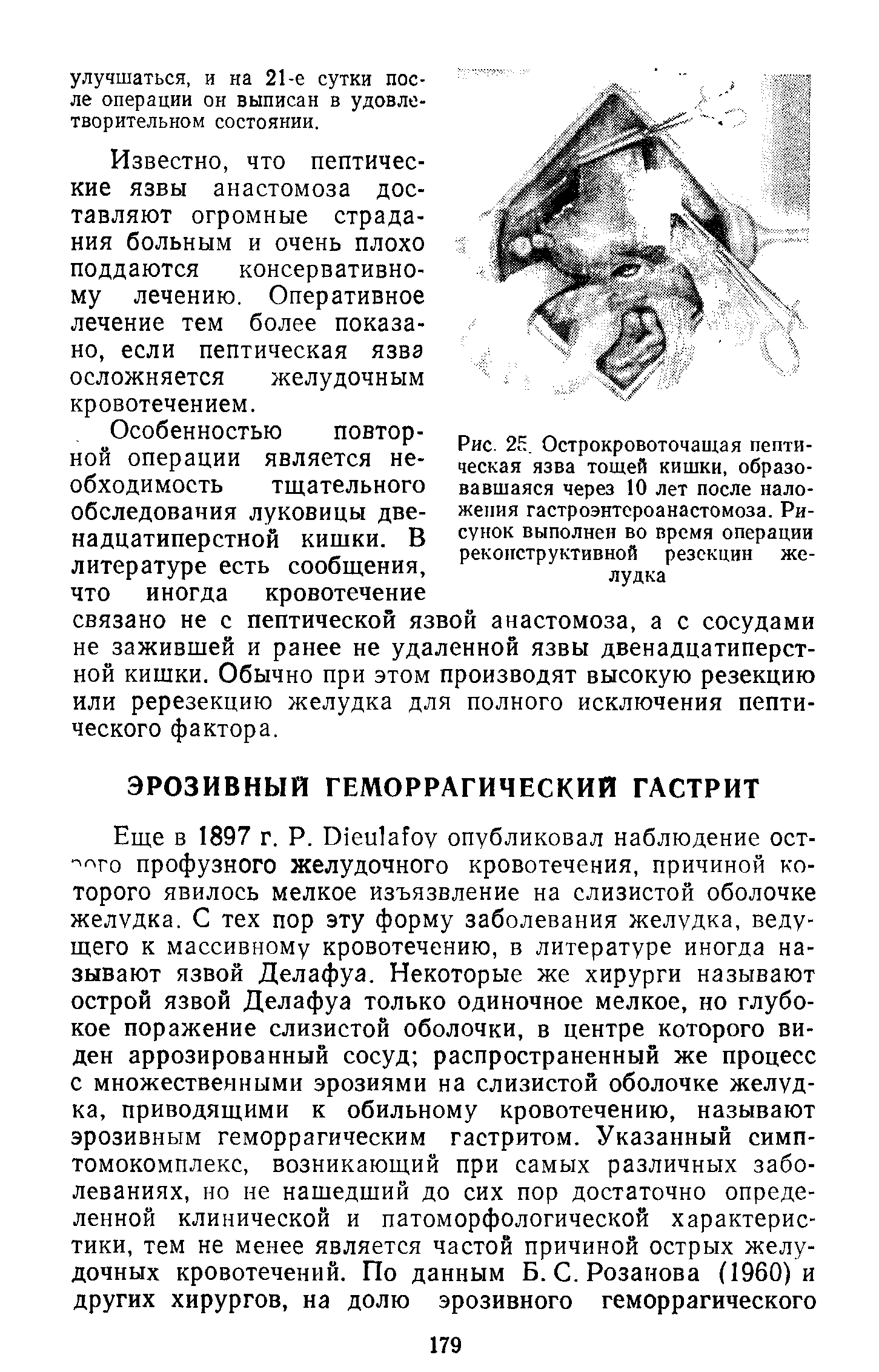 Рис. 2Е. Острокровоточащая пептическая язва тощей кишки, образовавшаяся через 10 лет после наложения гастроэнтероанастомоза. Рисунок выполнен во время операции реконструктивной резекции желудка...