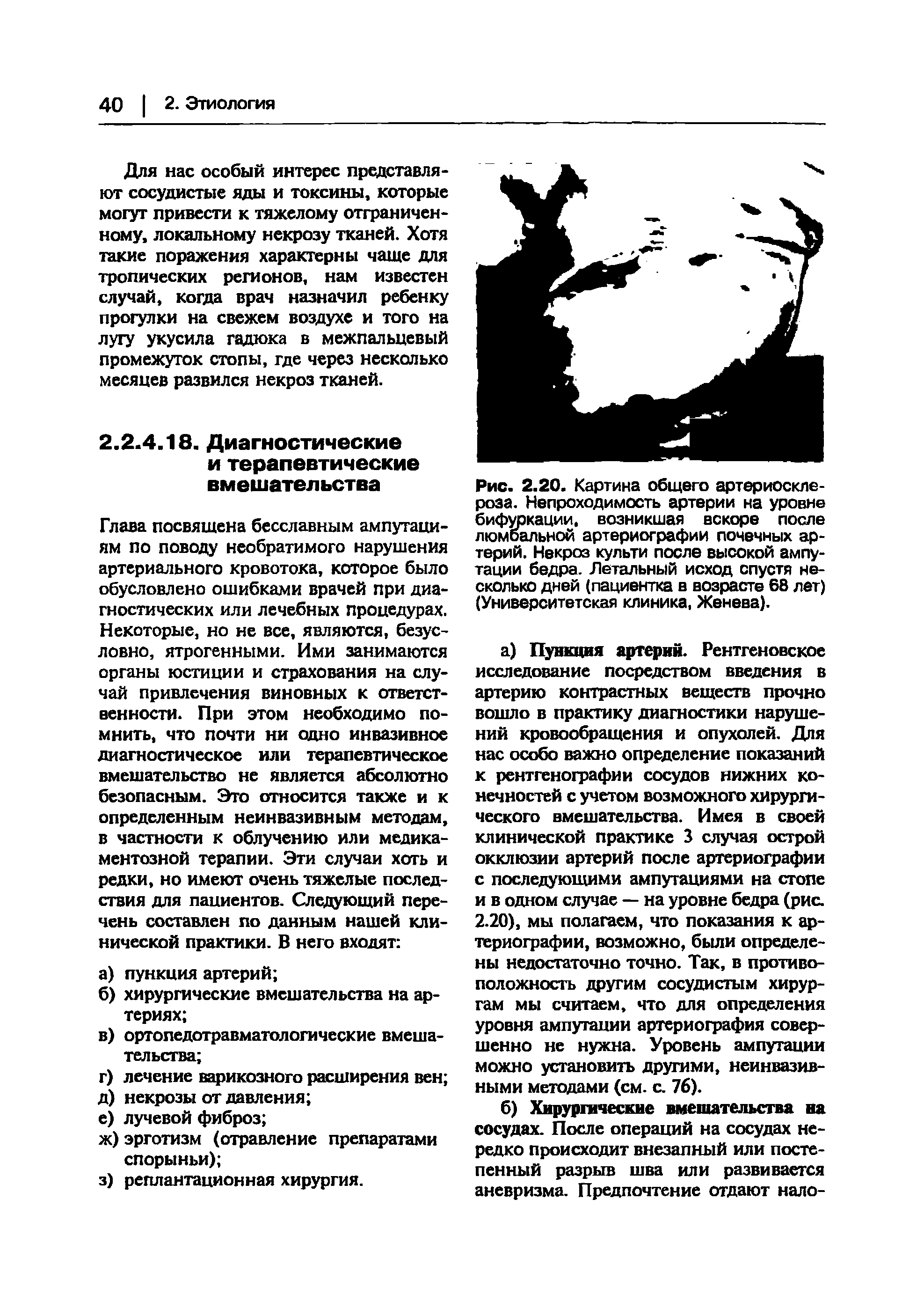 Рис. 2.20. Картина общего артериосклероза. Непроходимость артерии на уровне бифуркации, возникшая вскоре после люмбальной артериографии почечных артерий. Некроз культи после высокой ампутации бедра. Летальный исход спустя несколько дней (пациентка в возрасте 68 лет) (Университетская клиника, Женева).