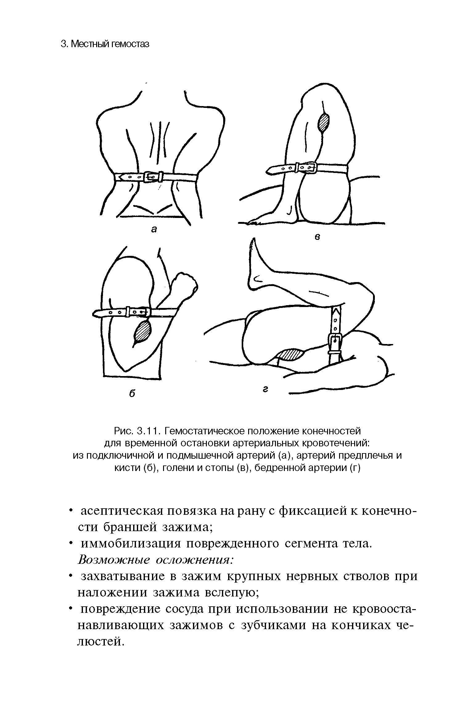 Рис. 3.11. Гемостатическое положение конечностей для временной остановки артериальных кровотечений из подключичной и подмышечной артерий (а), артерий предплечья и кисти (б), голени и стопы (в), бедренной артерии (г)...