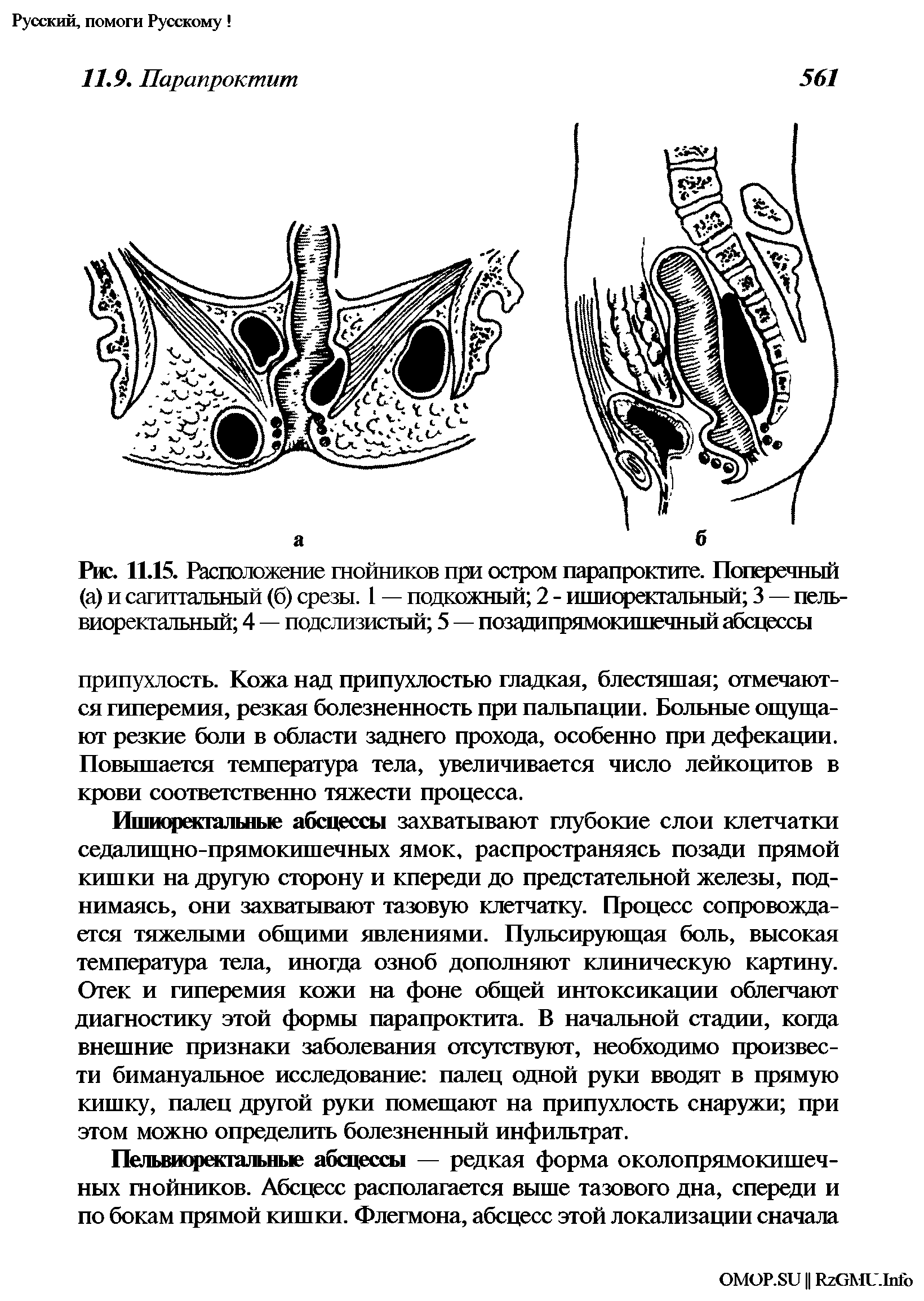 Рис. 11.15. Расположение гнойников при остром парапроктите. Поперечный (а) и сагиттальный (б) срезы. 1 — подкожный 2 - ишиоректальный 3 — пельвиоректальный 4 — подслизистый 5 — позадипрямокишечный абсцессы...