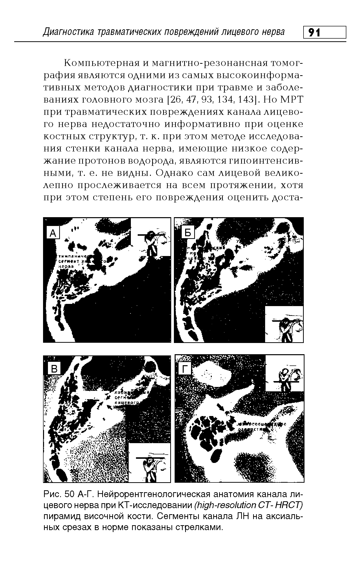 Рис. 50 А-Г. Нейрорентгенологическая анатомия канала лицевого нерва при КТ-исследовании ( - СТ- HRCT) пирамид височной кости. Сегменты канала ЛН на аксиальных срезах в норме показаны стрелками.