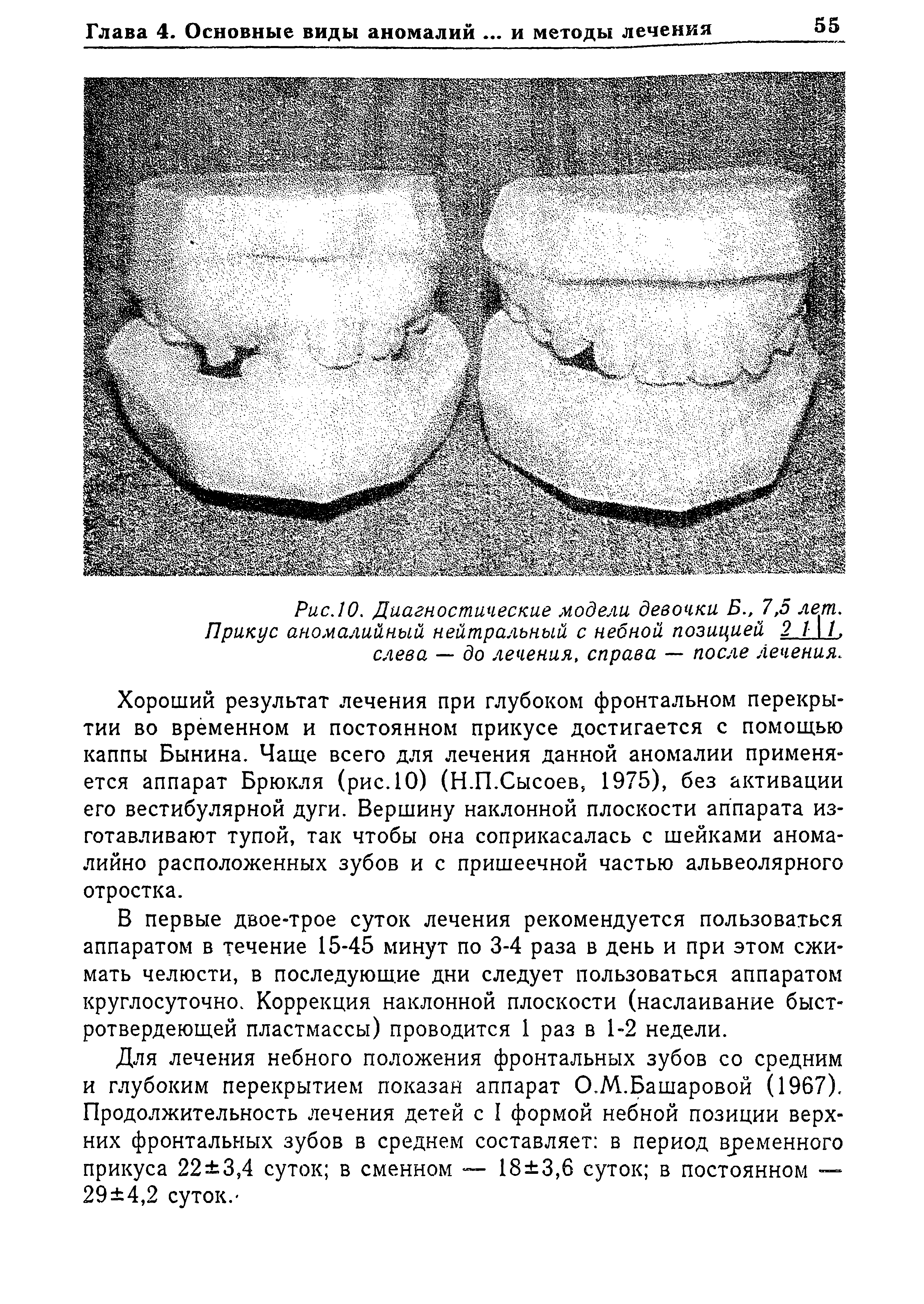 Рис. 10. Диагностические модели девочки Б.,7,5 лет. Прикус аномалийный нейтральный с небной позицией 2 1 1, слева — до лечения, справа — после Лечения.