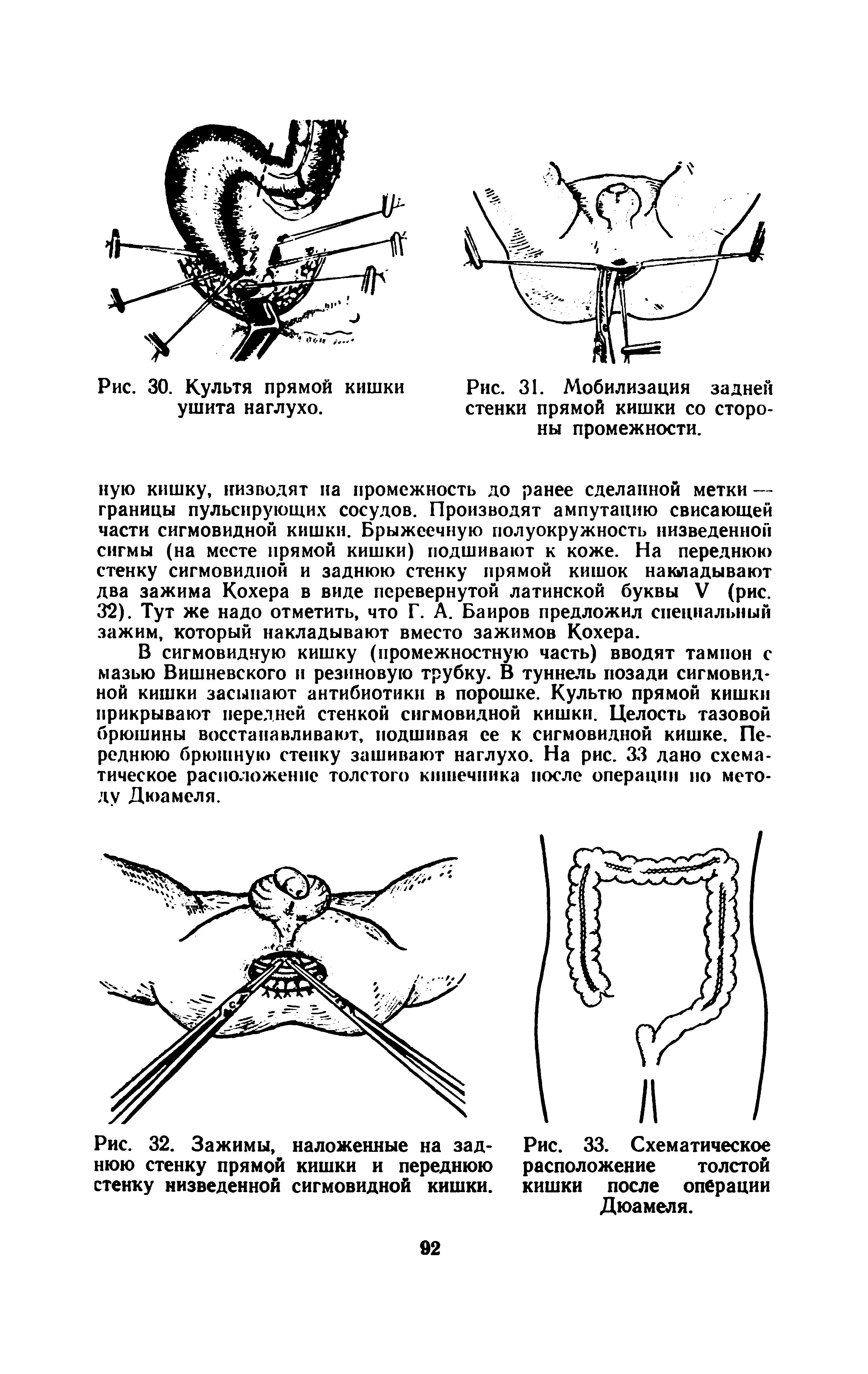 Рис. 33. Схематическое расположение толстой кишки после операции Дюамеля.