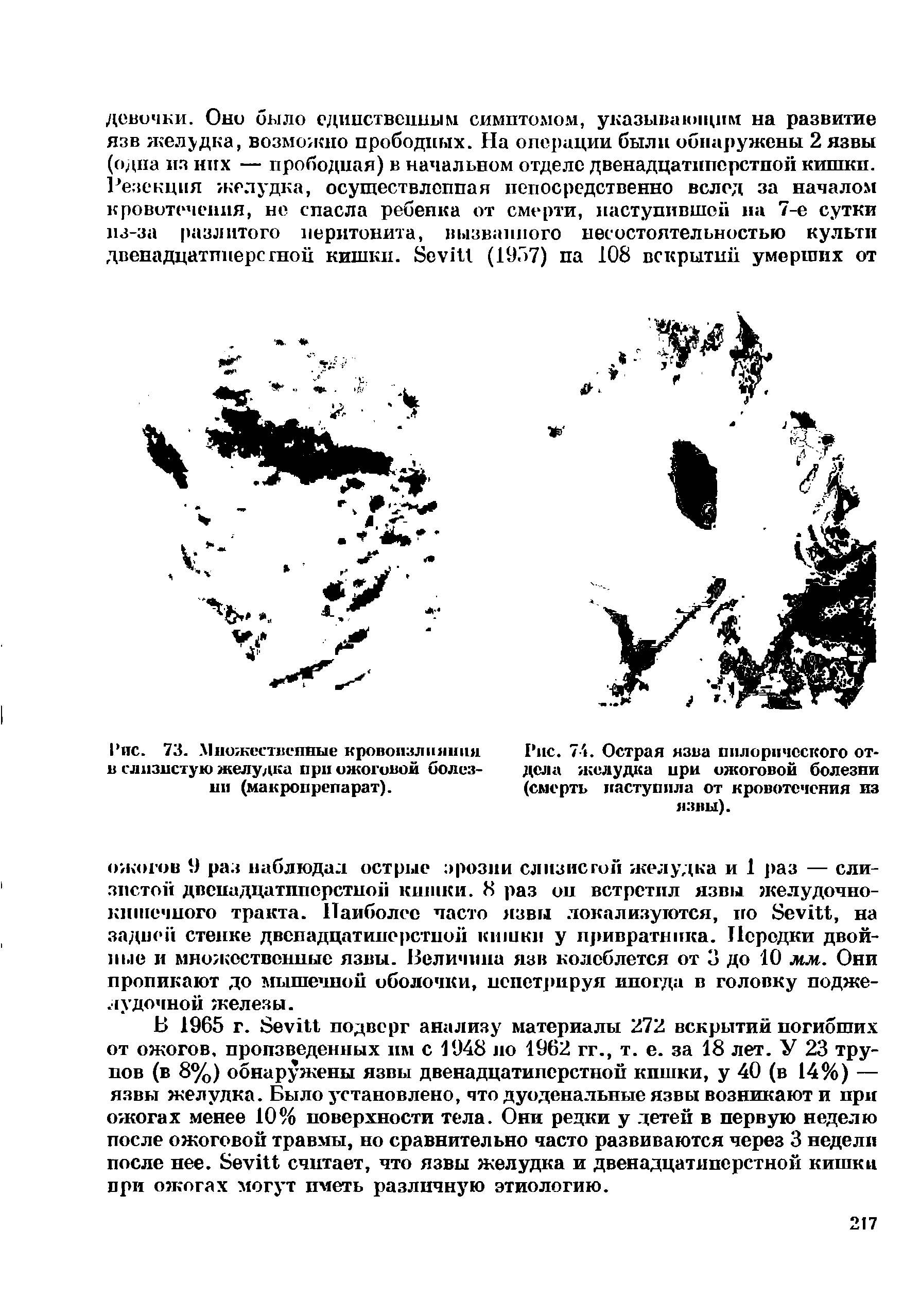 Рис. 73. Множественные кровоизлияния в слизистую желудка при ожоговой болезни (макропрепарат).