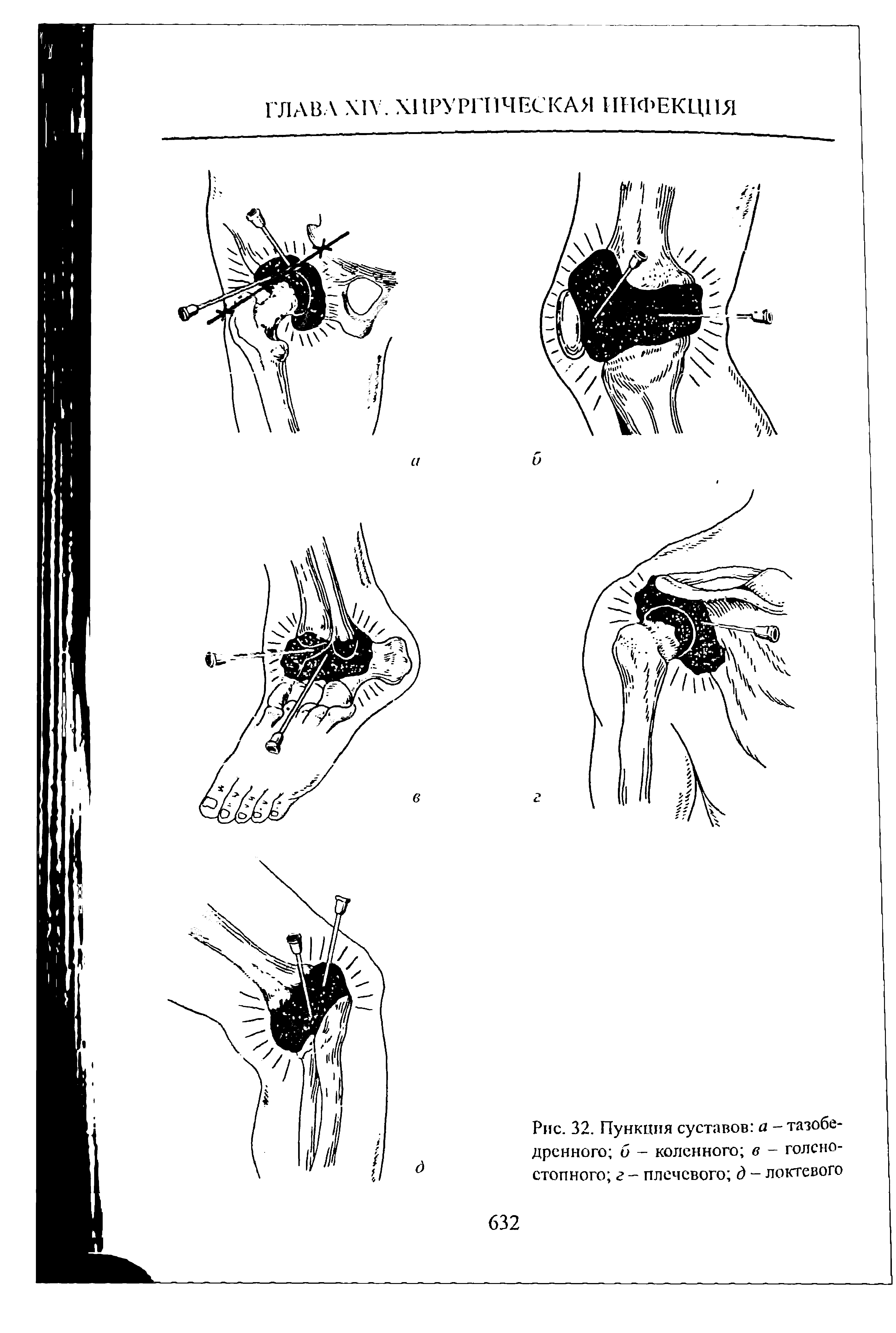 Рис. 32. Пункция суставов а - тазобедренного б - коленного в - голеностопного г - плечевого д - локтевого...