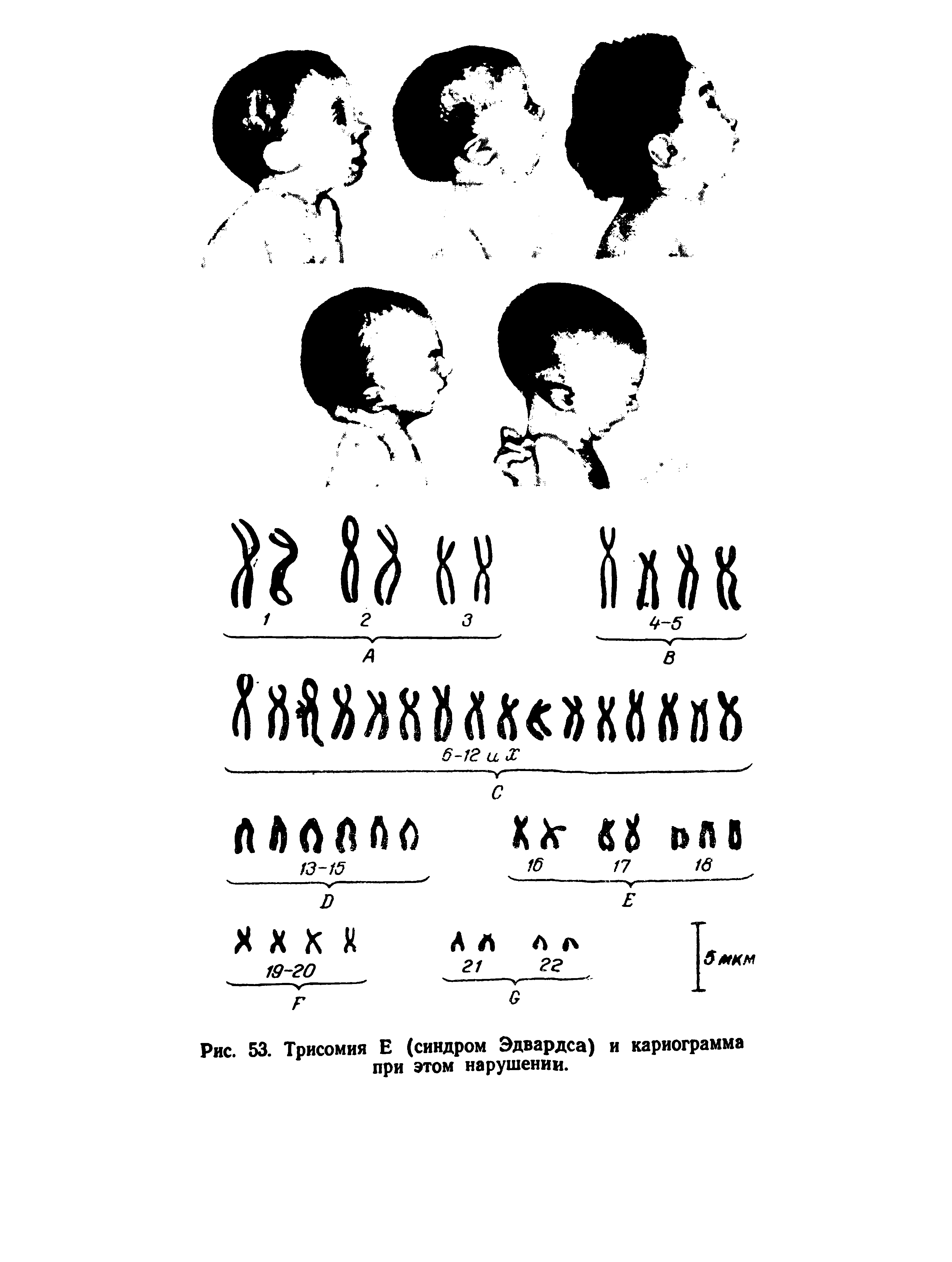 Рис. 53. Трисомия Е (синдром Эдвардса) и кариограмма при этом нарушении.