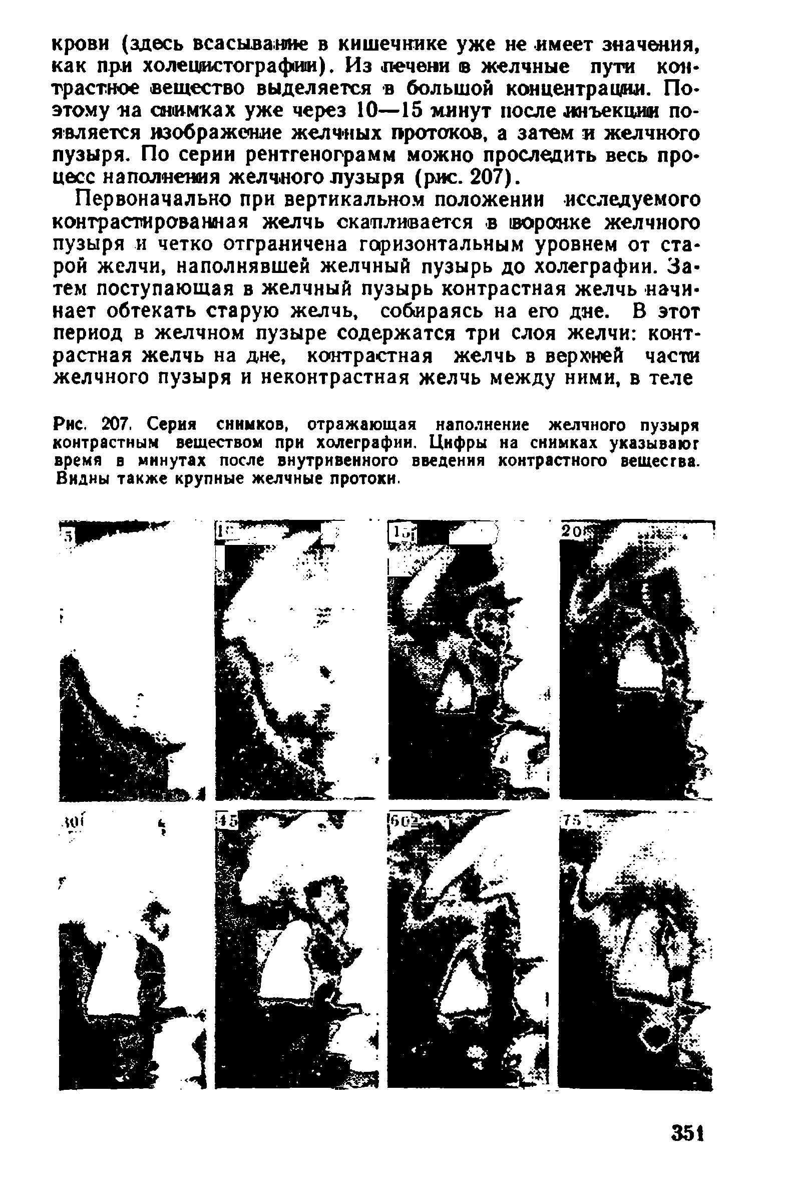 Рис. 207. Серия снимков, отражающая наполнение желчного пузыря контрастным веществом при холеграфии. Цифры на снимках указывают время в минутах после внутривенного введения контрастного вещества. Видны также крупные желчные протоки.