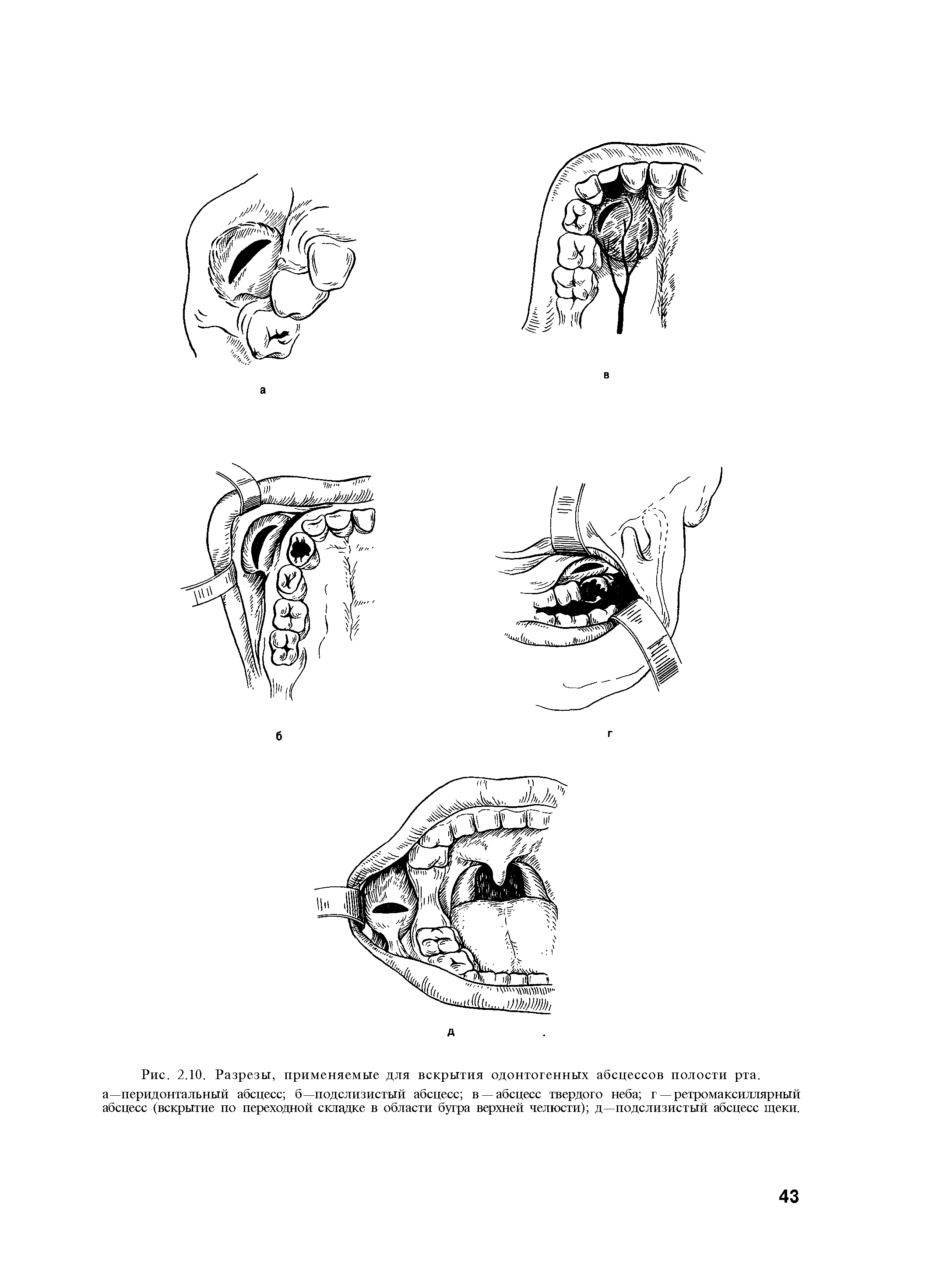 Рис. 2.10. Разрезы, применяемые для вскрытия одонтогенных абсцессов полости рта. а—перидонтальный абсцесс б—подслизистый абсцесс в —абсцесс твердого неба г — ретромаксиллярный абсцесс (вскрытие по переходной складке в области бугра верхней челюсти) д—подслизистый абсцесс щеки.