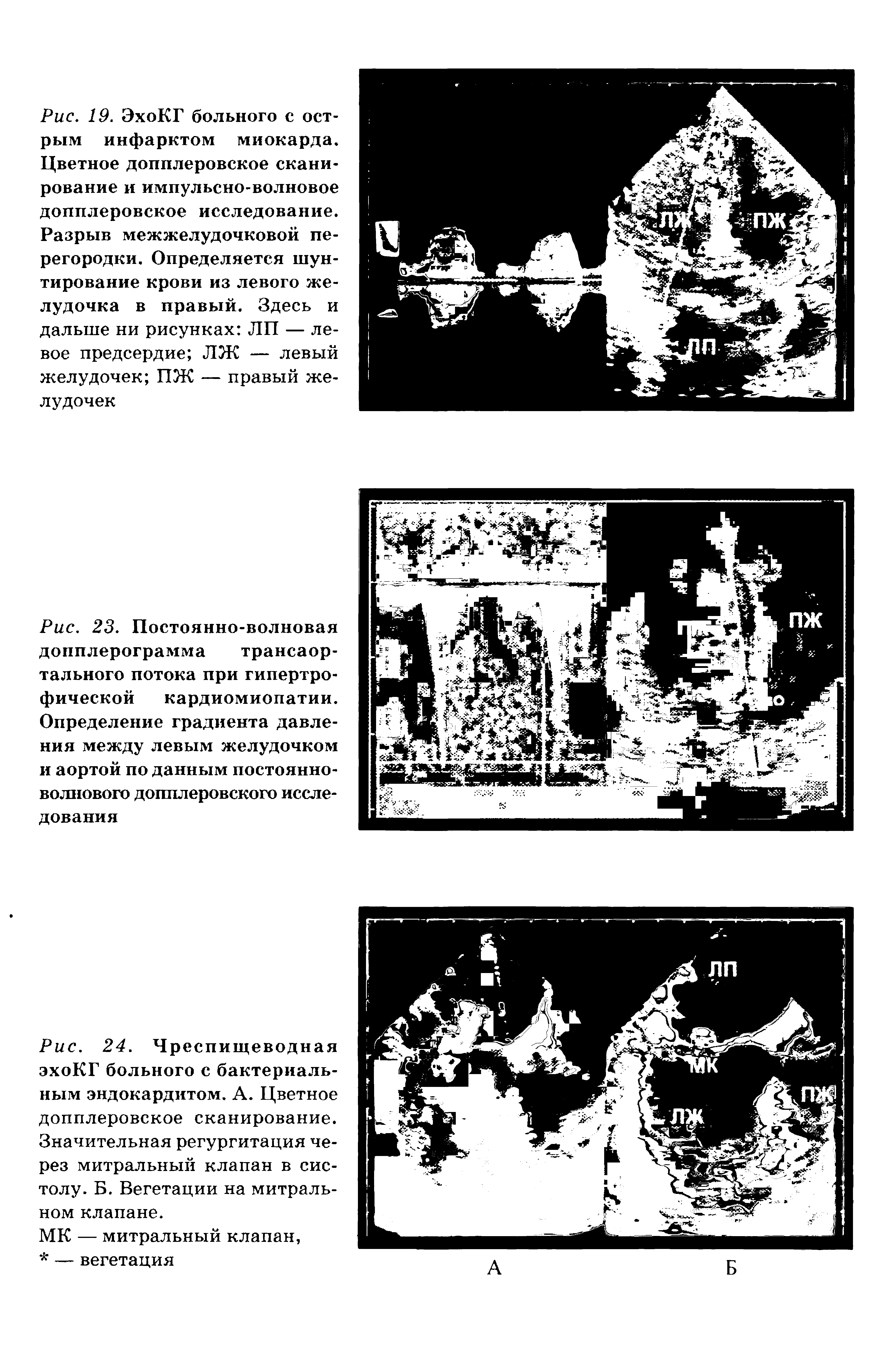 Рис. 24. Чреспищеводная эхоКГ больного с бактериальным эндокардитом. А. Цветное допплеровское сканирование. Значительная регургитация через митральный клапан в систолу. Б. Вегетации на митральном клапане.