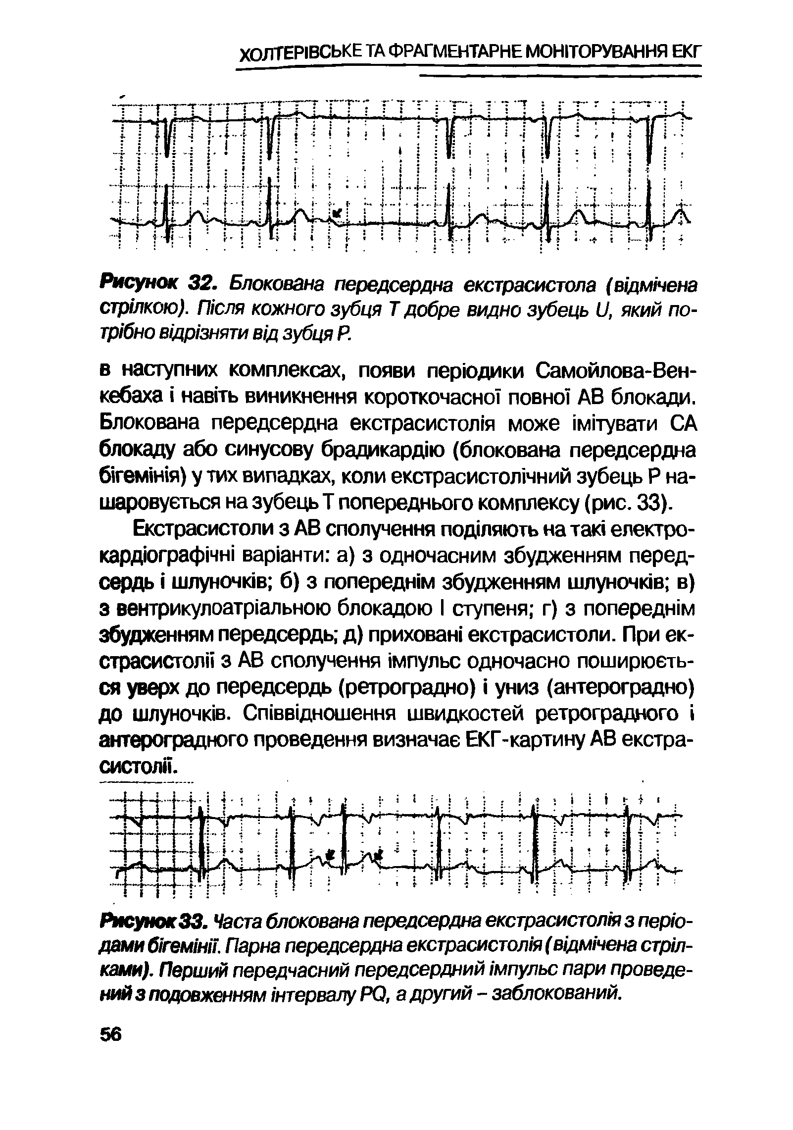 РисунокЗЗ. Часта блокована передсердна екстрасистоли з перю-дами гем1Н1Т Парна передсердна екстрасистол1я (вщмнена строками). Перший передчасний передсердний мпульс пари проведений зподовженням нтервалуРО, адругий - заблокований.