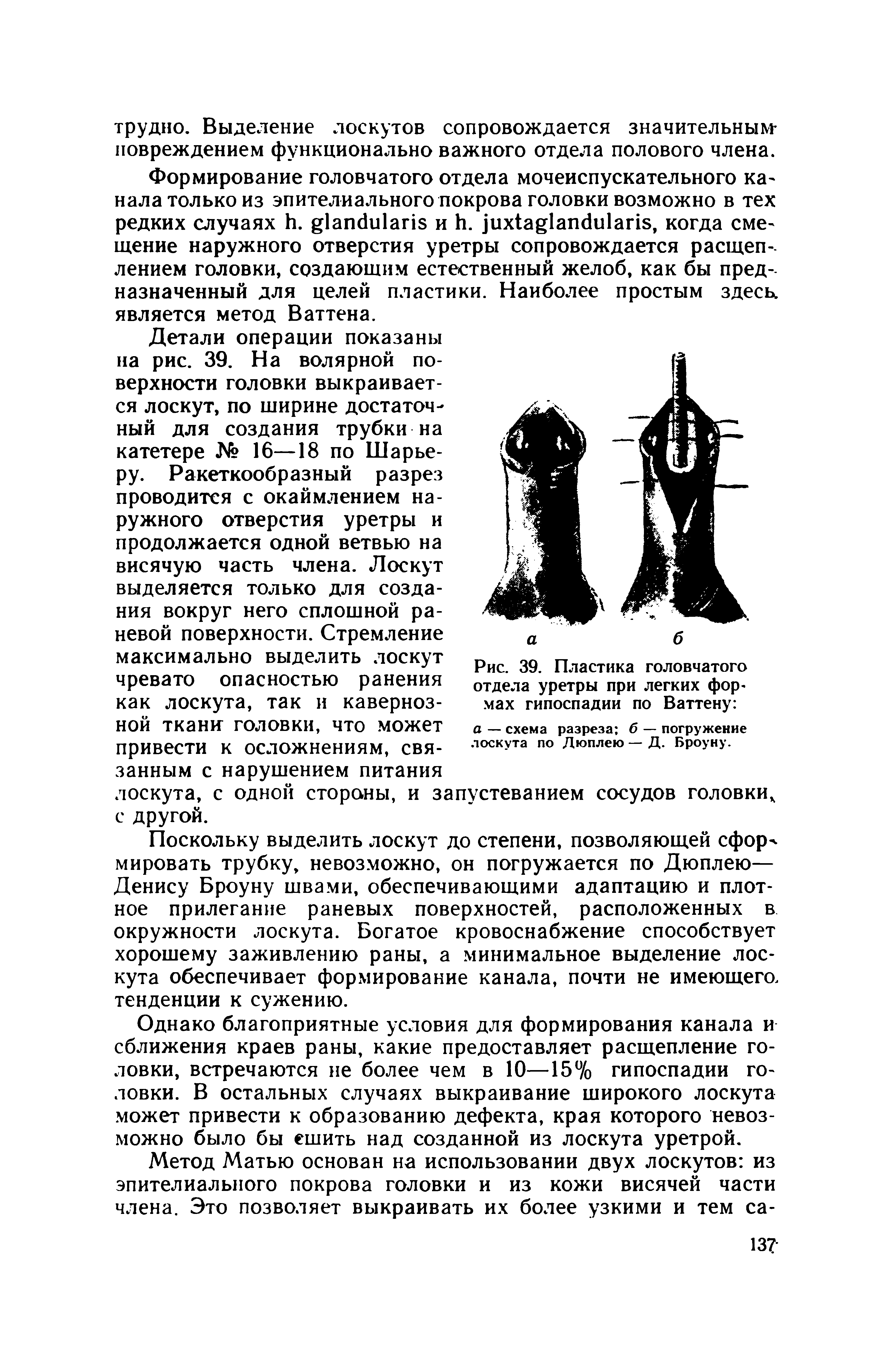 Рис. 39. Пластика головчатого отдела уретры при легких фор, мах гипоспадии по Баттену ...