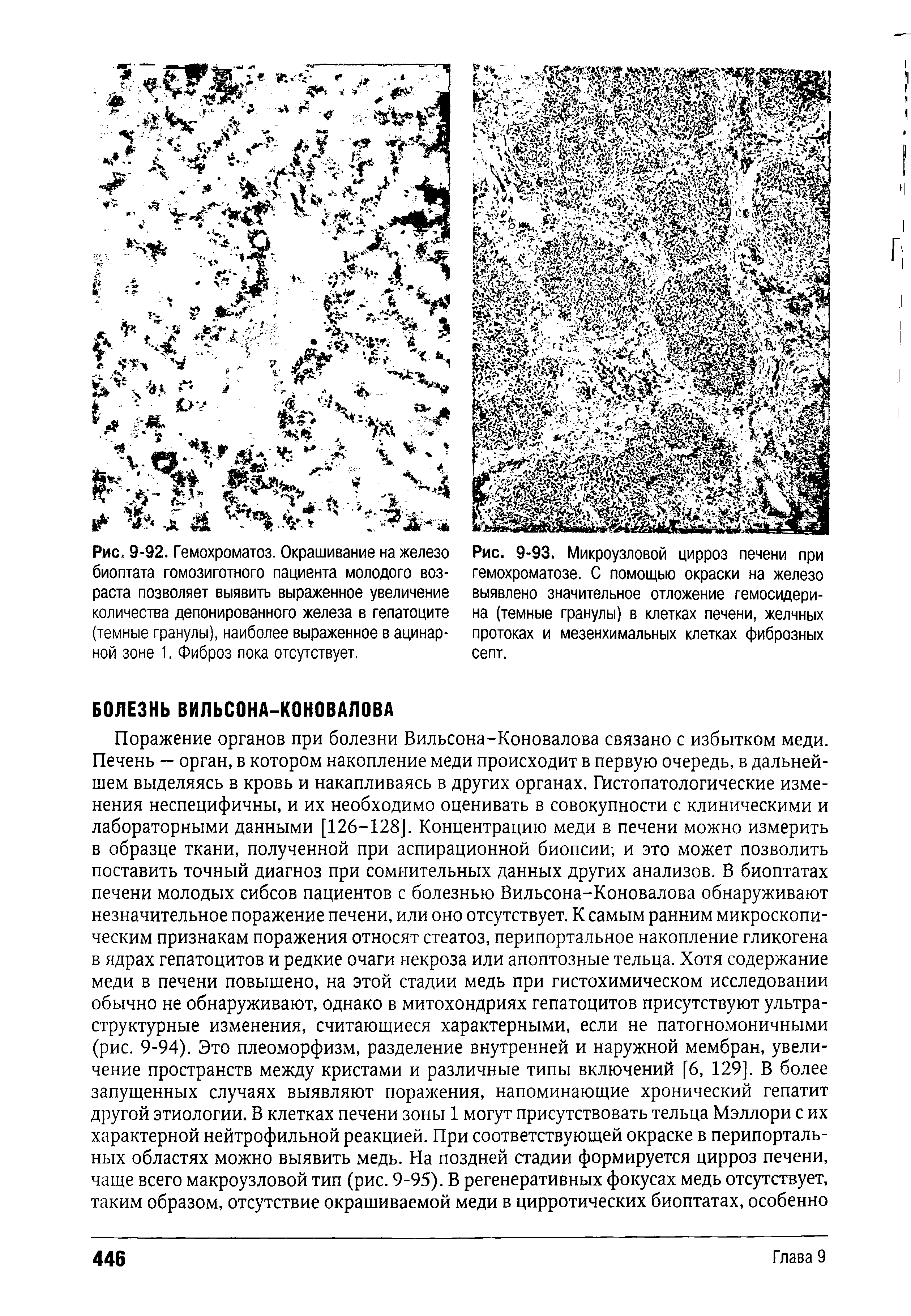 Рис. 9-93. Микроузловой цирроз печени при гемохроматозе. С помощью окраски на железо выявлено значительное отложение гемосидерина (темные гранулы) в клетках печени, желчных протоках и мезенхимальных клетках фиброзных септ.