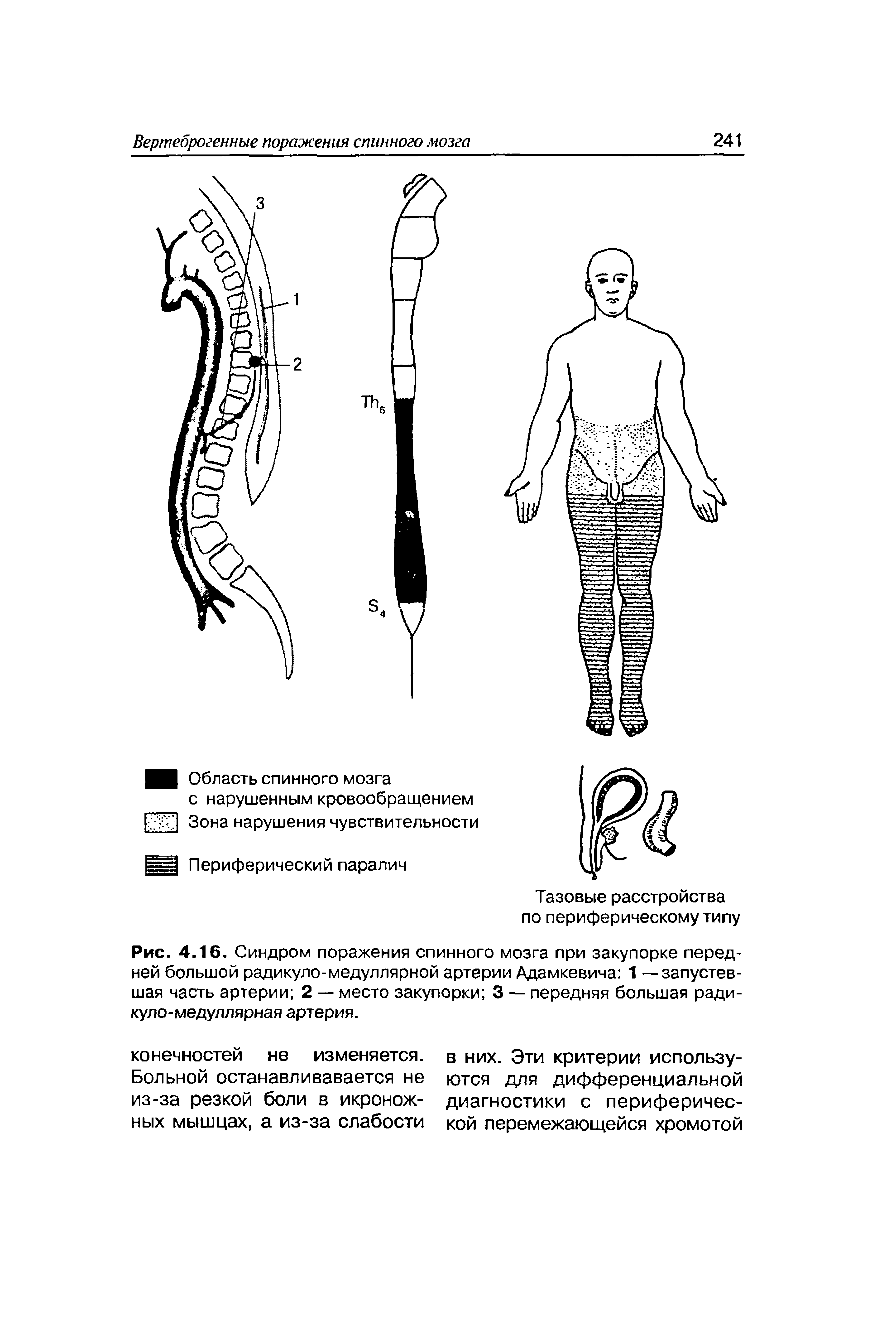 Рис. 4.16. Синдром поражения спинного мозга при закупорке передней большой радикуло-медуллярной артерии Адамкевича 1 — запустевшая часть артерии 2 — место закупорки 3 — передняя большая ради-куло-медуллярная артерия.