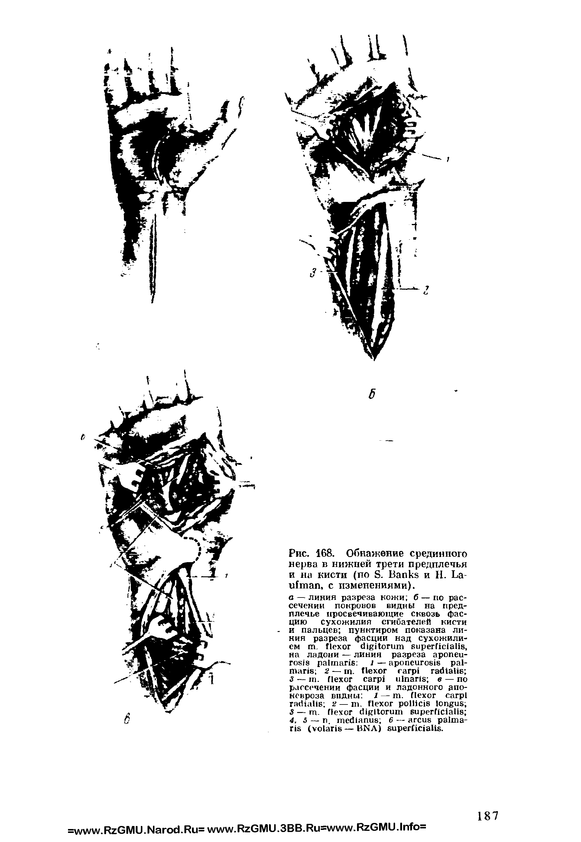 Рис. 168. Обнажение срединного нерва в нижней трети предплечья и на кисти (по S. B и 11. L , с изменениями).