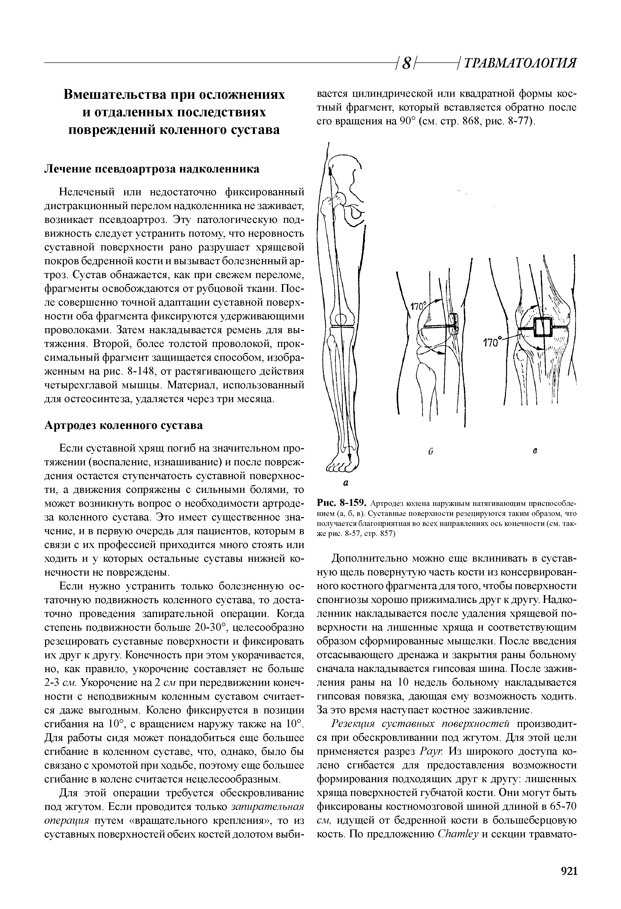 Рис. 8-159. Артродез колена наружным натягивающим приспособле-нием (а, б, в). Суставные поверхности резецируются таким образом, что получается благоприятная во всех направлениях ось конечности (см. также рис. 8-57, стр. 857)...