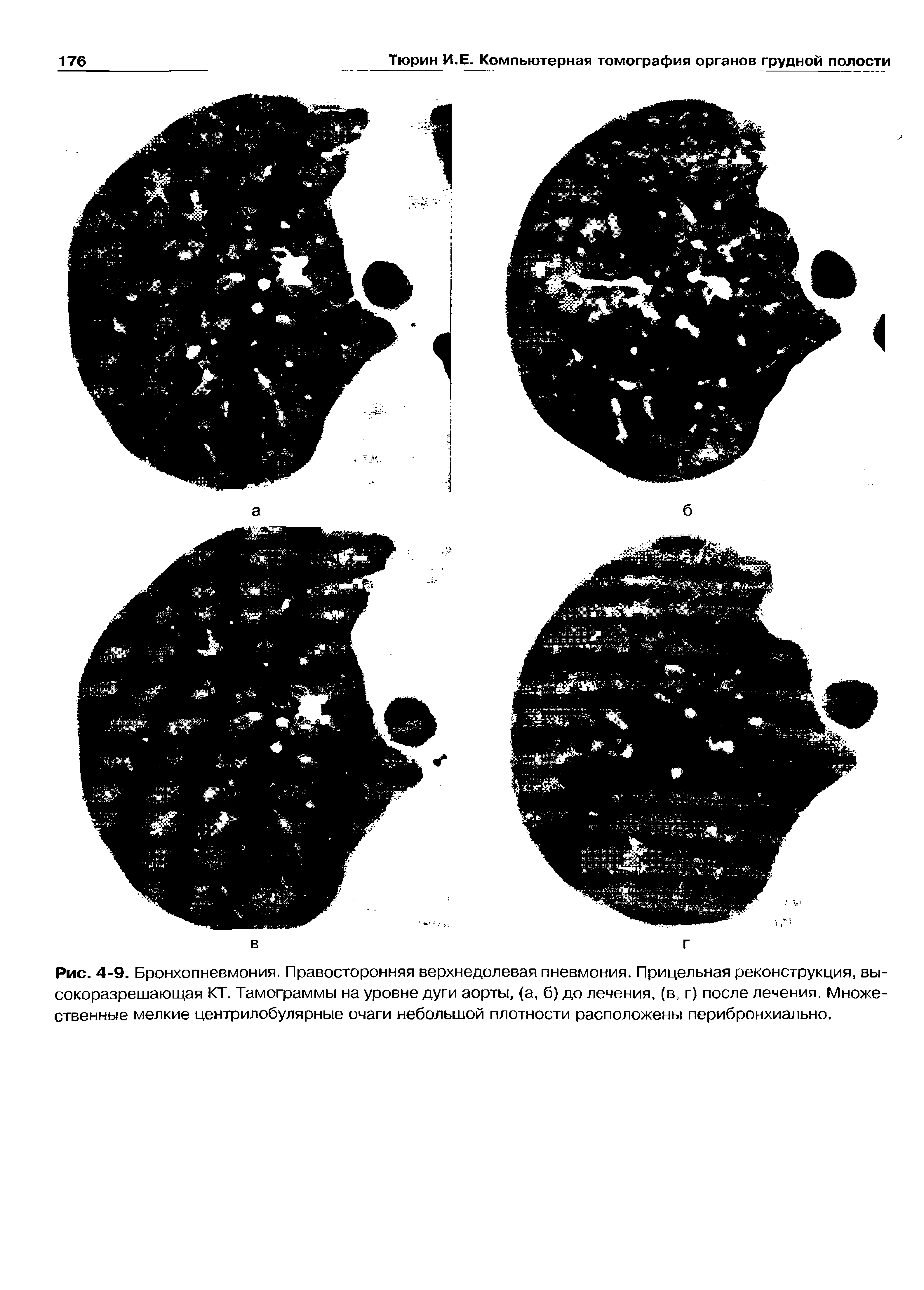 Рис. 4-9. Бронхопневмония. Правосторонняя верхнедолевая пневмония. Прицельная реконструкция, высокоразрешающая КТ. Тамограммы на уровне дуги аорты, (а, б) до лечения, (в, г) после лечения. Множественные мелкие центрилобулярные очаги небольшой плотности расположены перибронхиально.