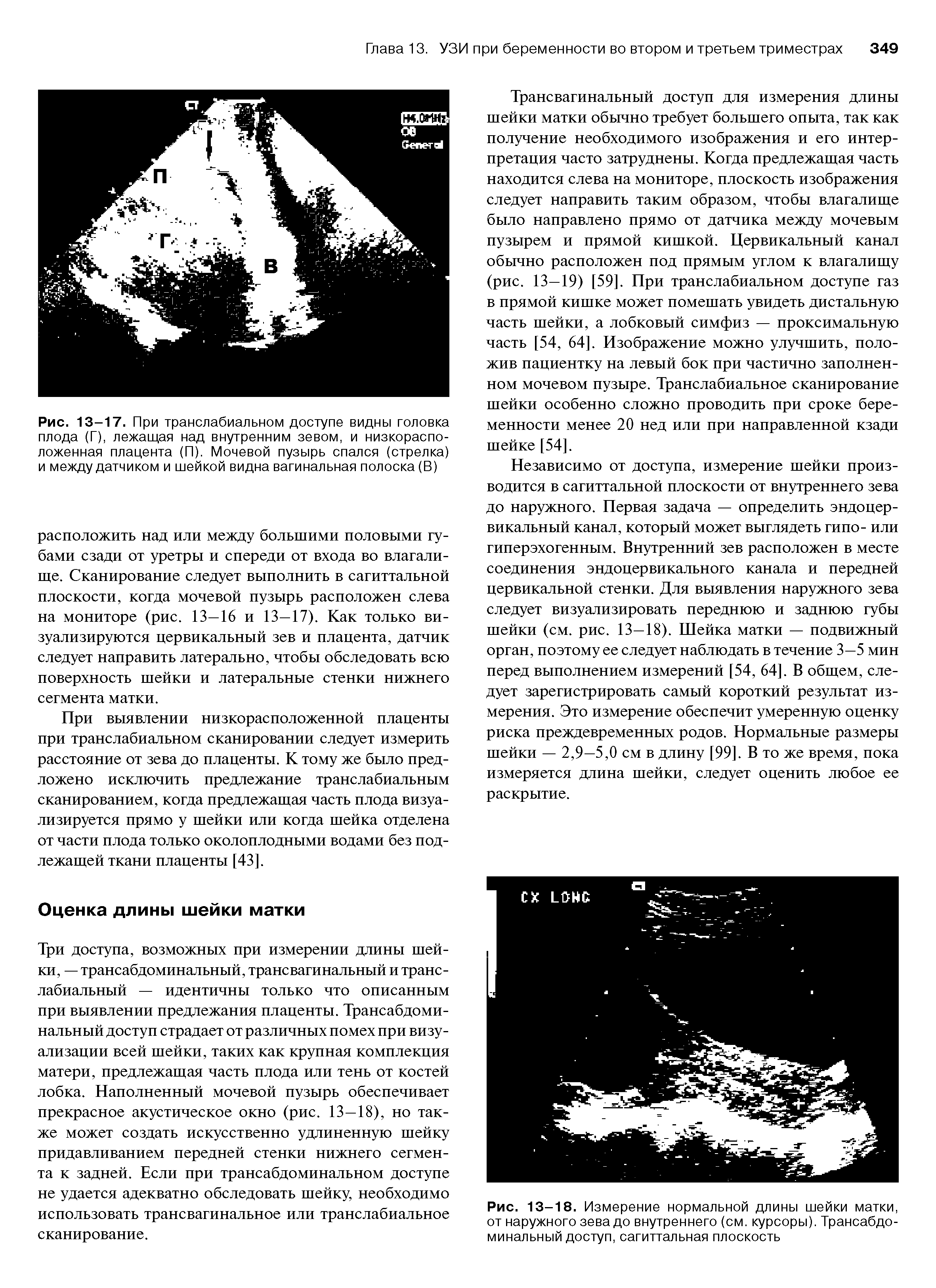 Рис. 13-17. При транслабиальном доступе видны головка плода (Г), лежащая над внутренним зевом, и низкорасположенная плацента (П). Мочевой пузырь спался (стрелка) и между датчиком и шейкой видна вагинальная полоска (В)...