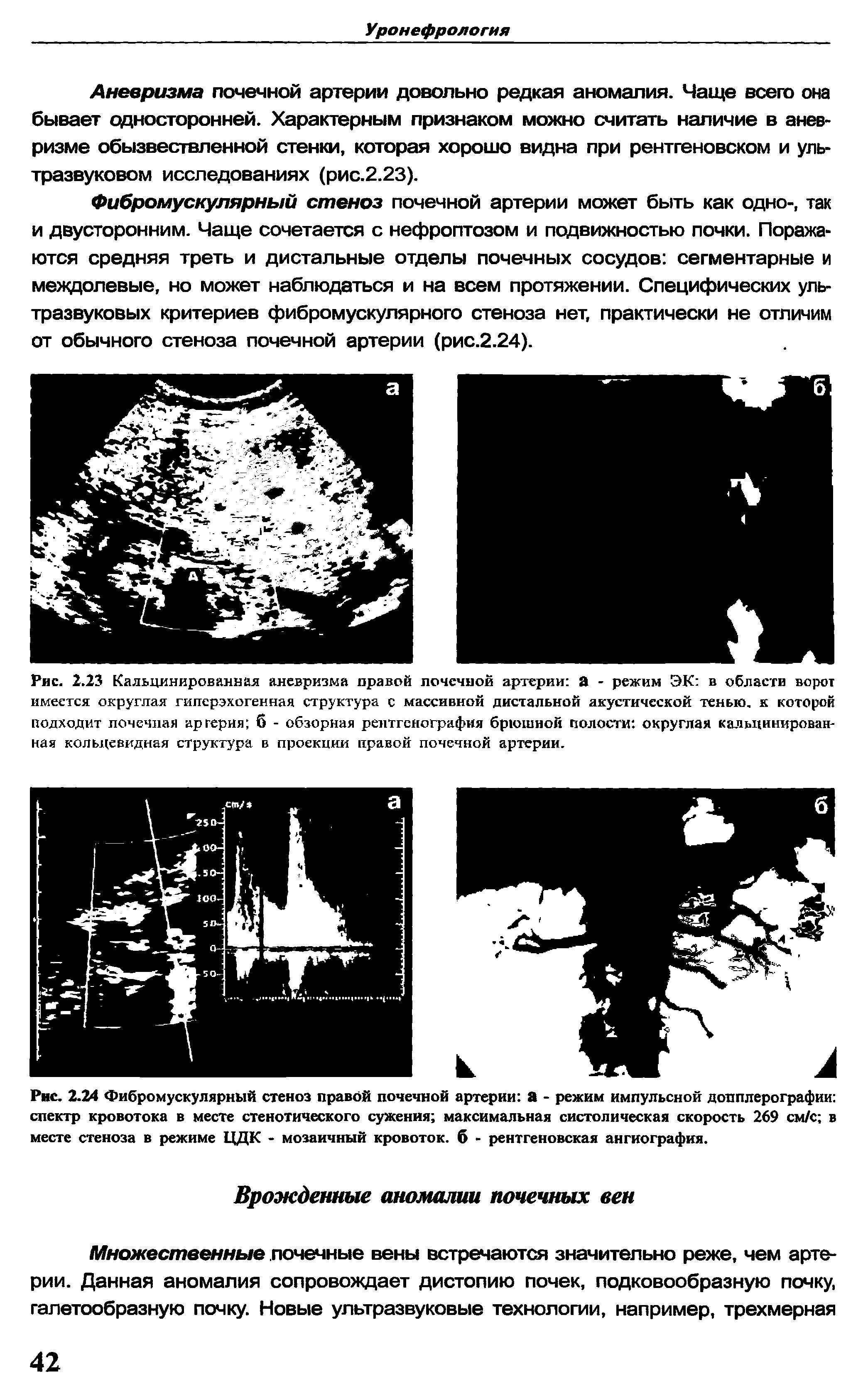 Рис. 2.24 Фибромускулярный стеноз правой почечной артерии а - режим импульсной допплерографии спектр кровотока в месте стенотического сужения максимальная систолическая скорость 269 см/с в месте стеноза в режиме ЦДК - мозаичный кровоток, б - рентгеновская ангиография.