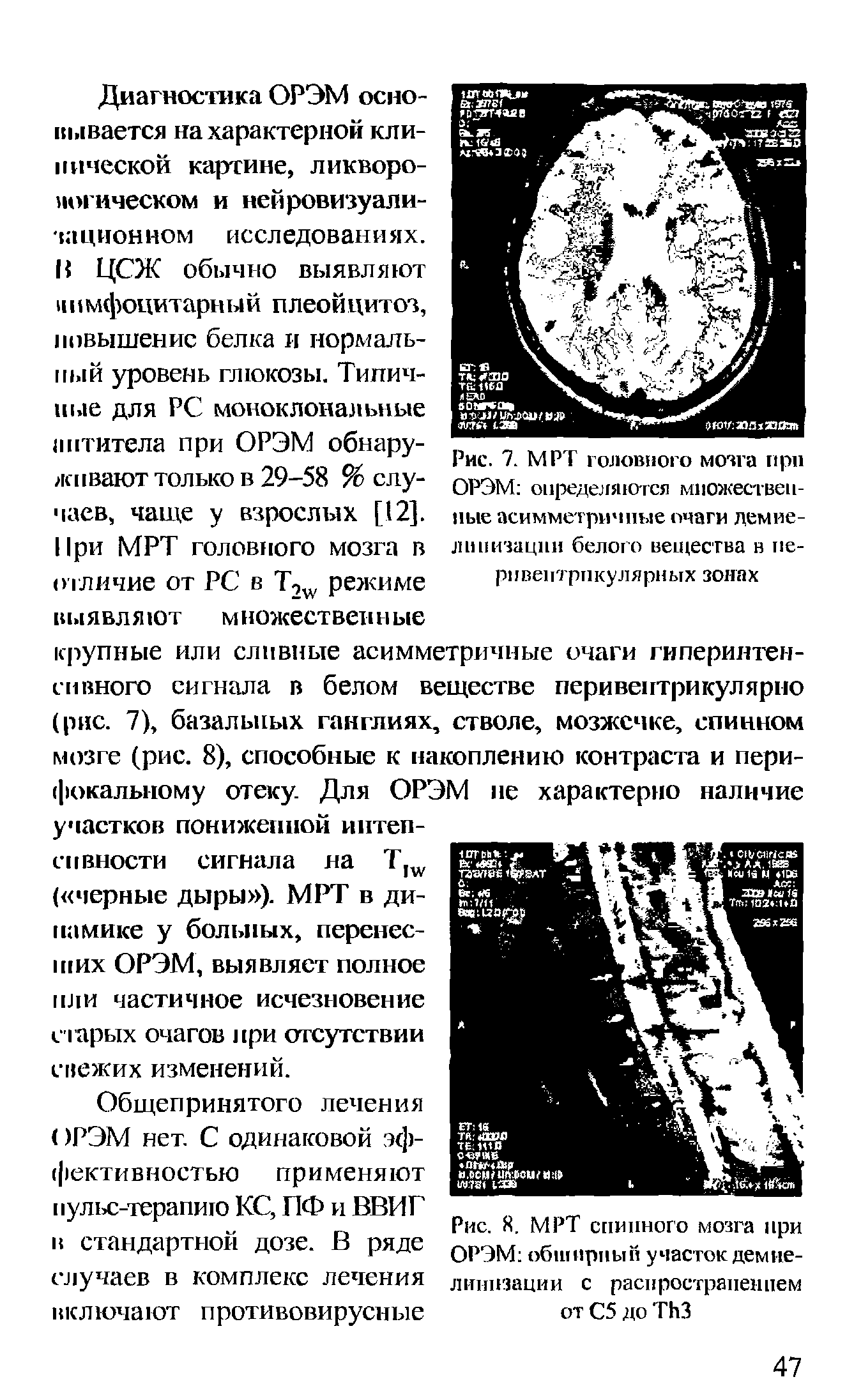 Рис. 7. МРТ головного мозга при ОРЭМ определяются множественные асимметричные очаги демиелинизации белого вещества в нерп вентрикулярных зонах...