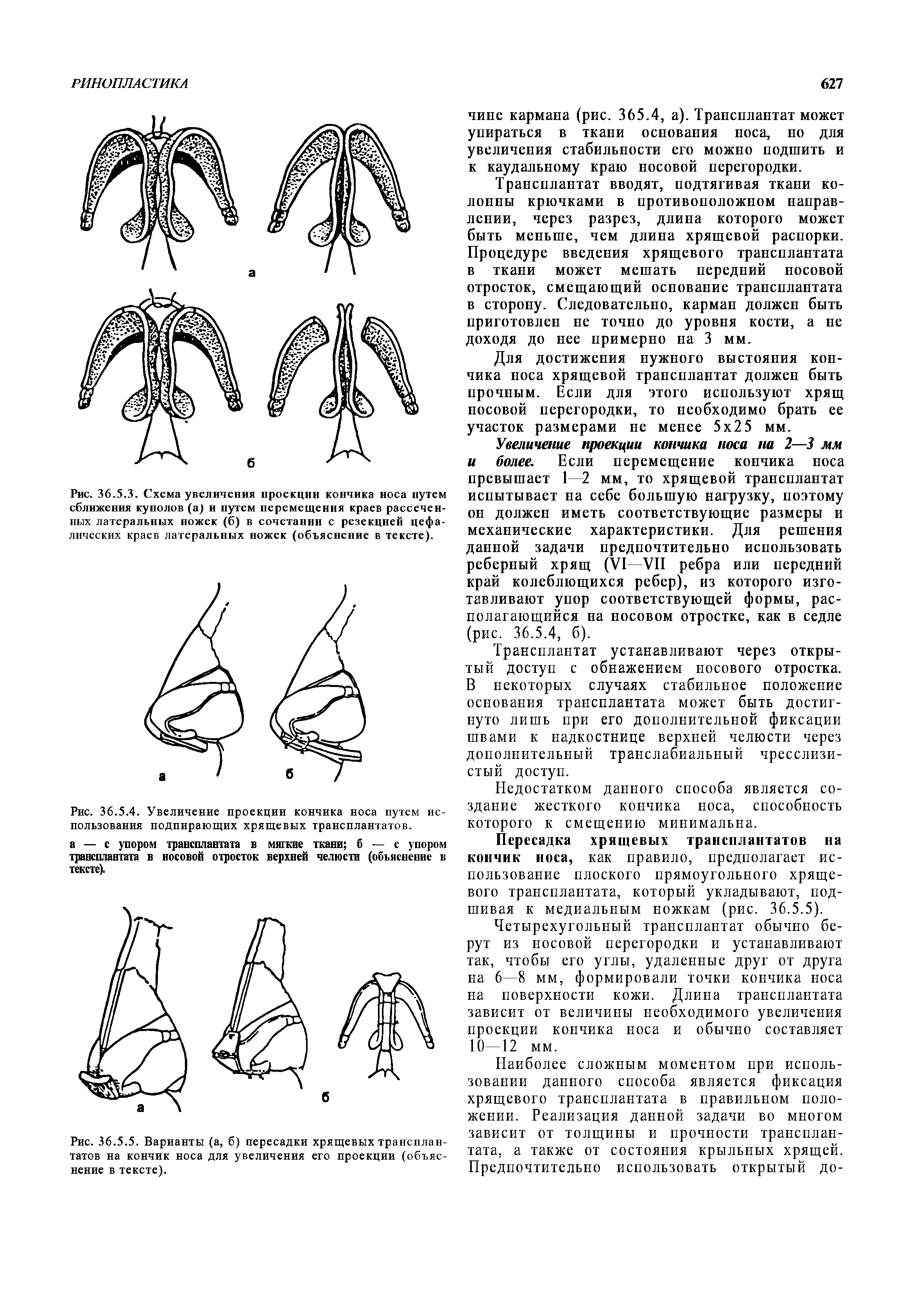 Рис. 36.5.3. Схема увеличения проекции кончика носа путем сближения куполов (а) и путем перемещения краев рассеченных латеральных ножек (6) в сочетании с резекцией цефалических краев латеральных ножек (объяснение в тексте).