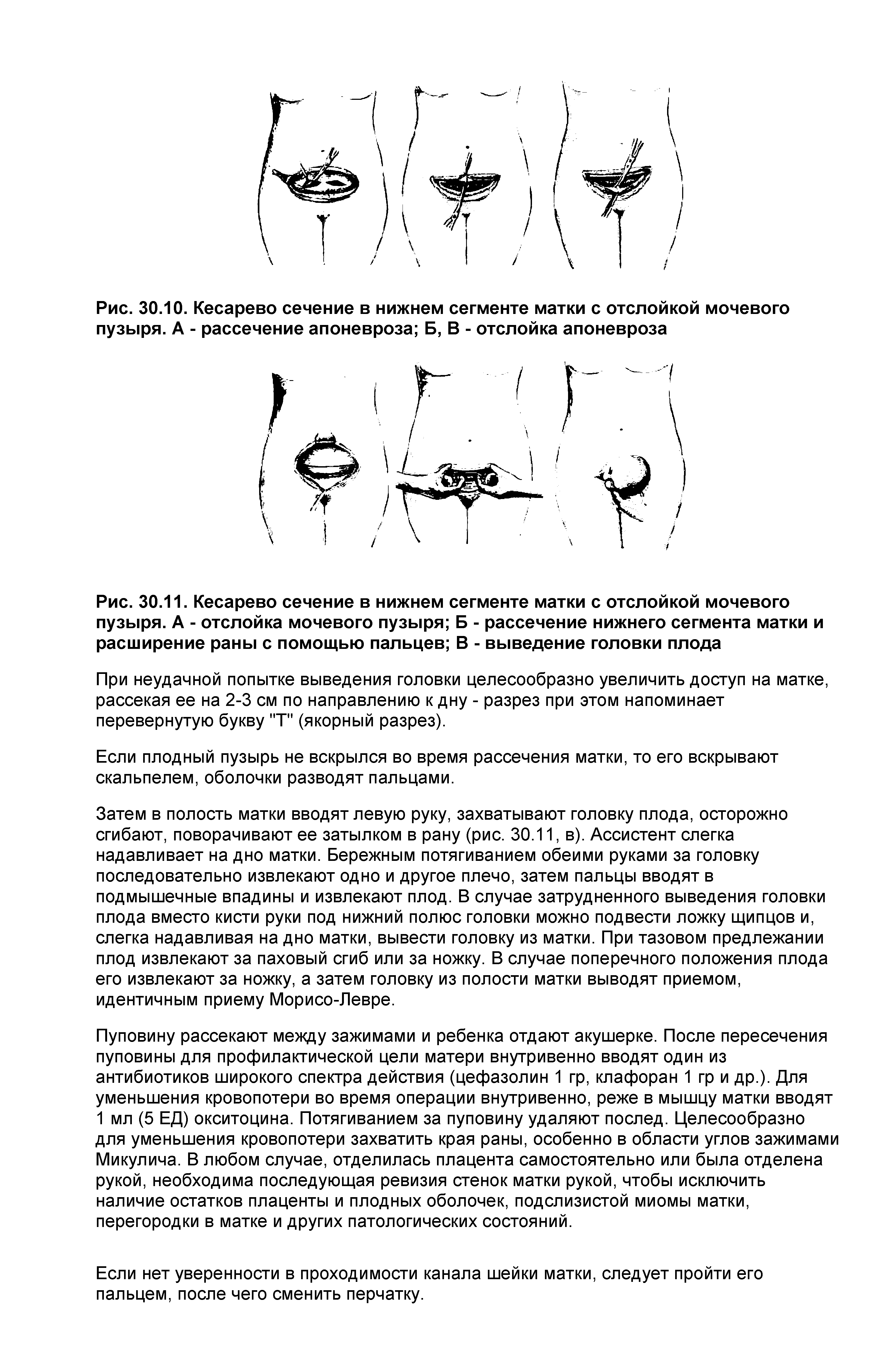 Рис. 30.11. Кесарево сечение в нижнем сегменте матки с отслойкой мочевого пузыря. А - отслойка мочевого пузыря Б - рассечение нижнего сегмента матки и расширение раны с помощью пальцев В - выведение головки плода...