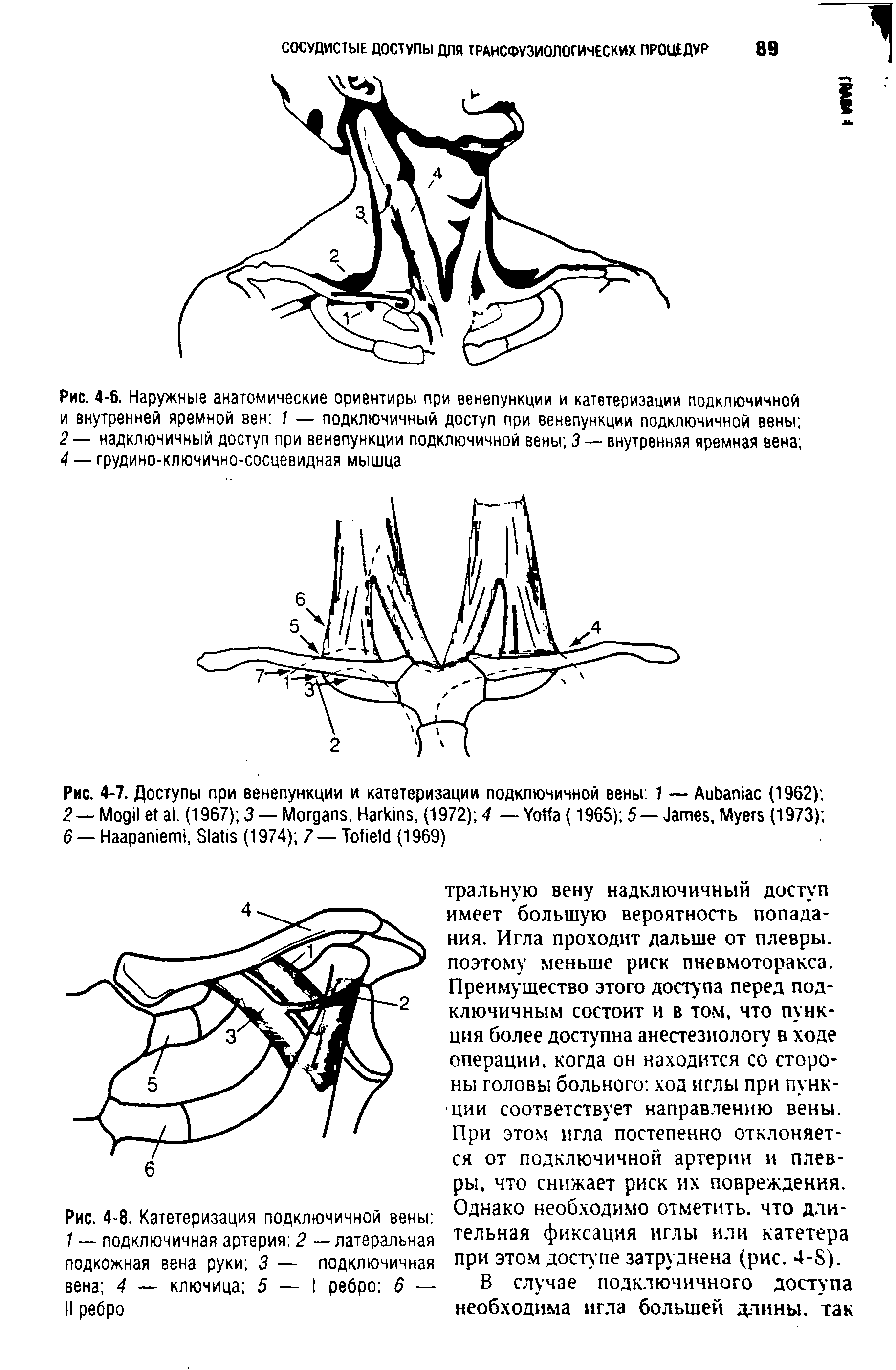 Рис. 4-6. Наружные анатомические ориентиры при венепункции и катетеризации подключичной и внутренней яремной вен 1 — подключичный доступ при венепункции подключичной вены 2— надключичный доступ при венепункции подключичной вены 3 — внутренняя яремная вена 4 — грудино-ключично-сосцевидная мышца...