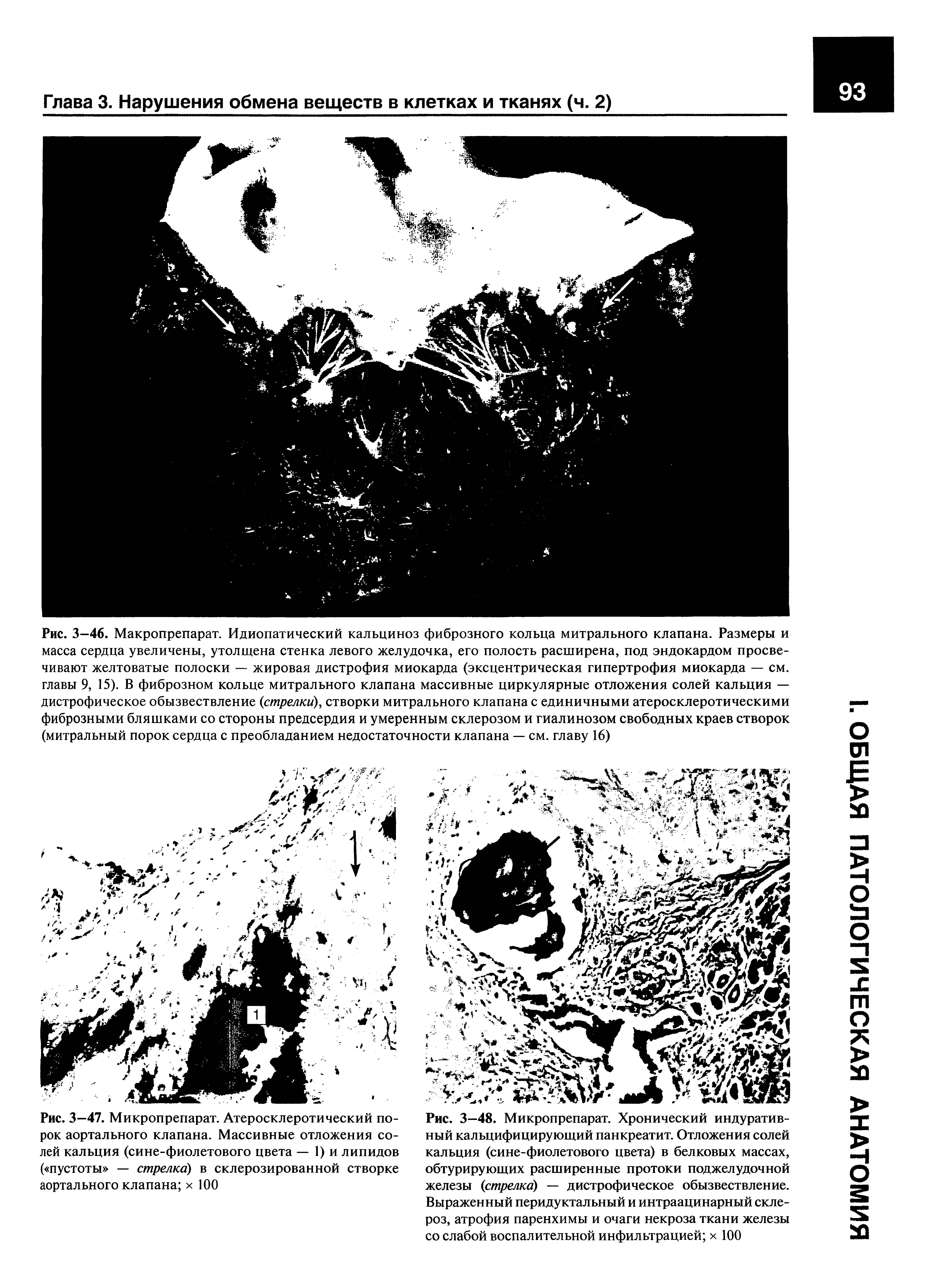 Рис. 3—48. Микропрепарат. Хронический индуратив-ный кальцифицирующий панкреатит. Отложения солей кальция (сине-фиолетового цвета) в белковых массах, обтурирующих расширенные протоки поджелудочной железы (стрелка) — дистрофическое обызвествление. Выраженный перидуктальный и интраацинарный склероз, атрофия паренхимы и очаги некроза ткани железы со слабой воспалительной инфильтрацией х 100...