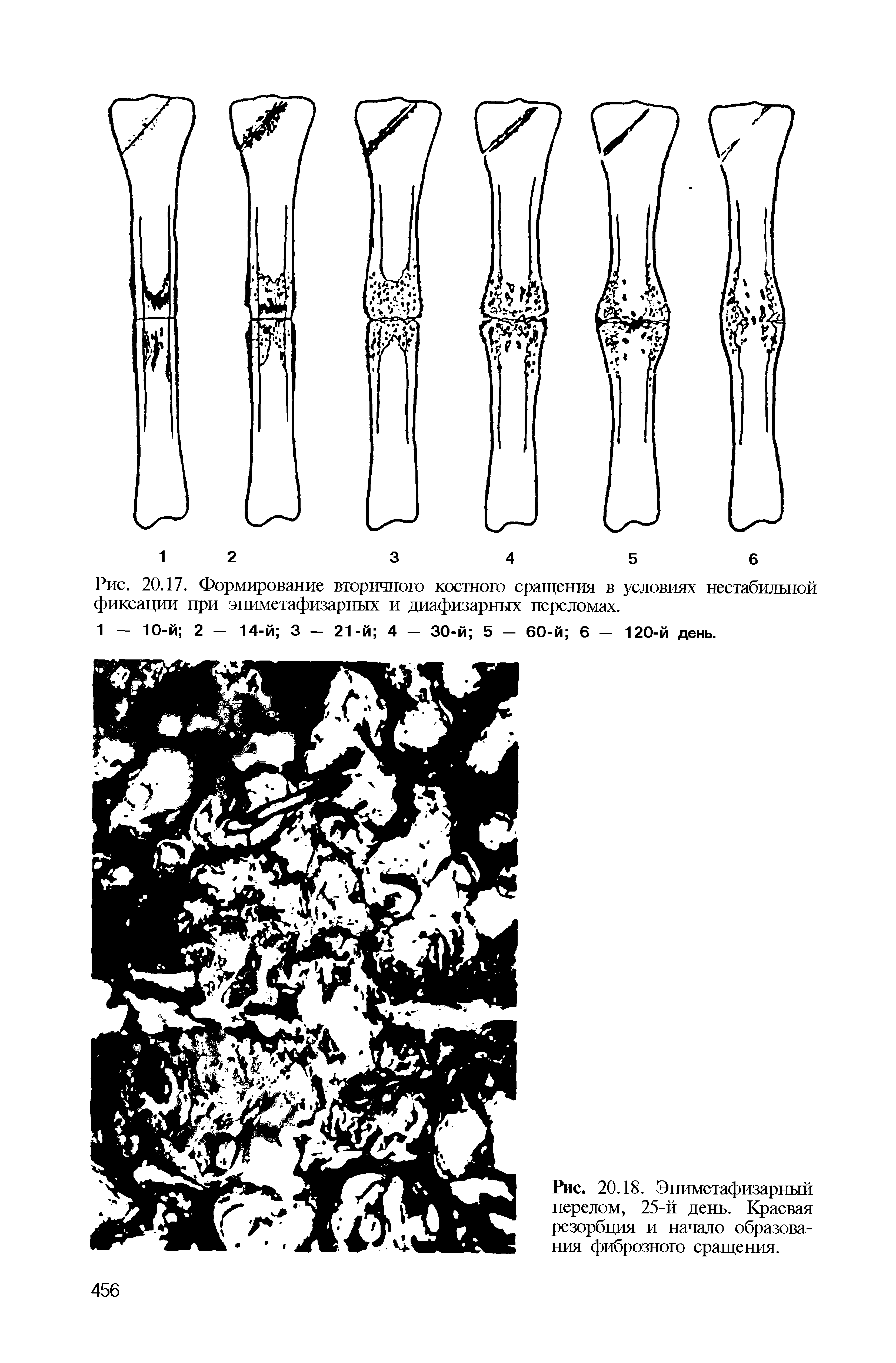 Рис. 20.18. Эпиметафизарный перелом, 25-й день. Краевая резорбция и начало образования фиброзного сращения.