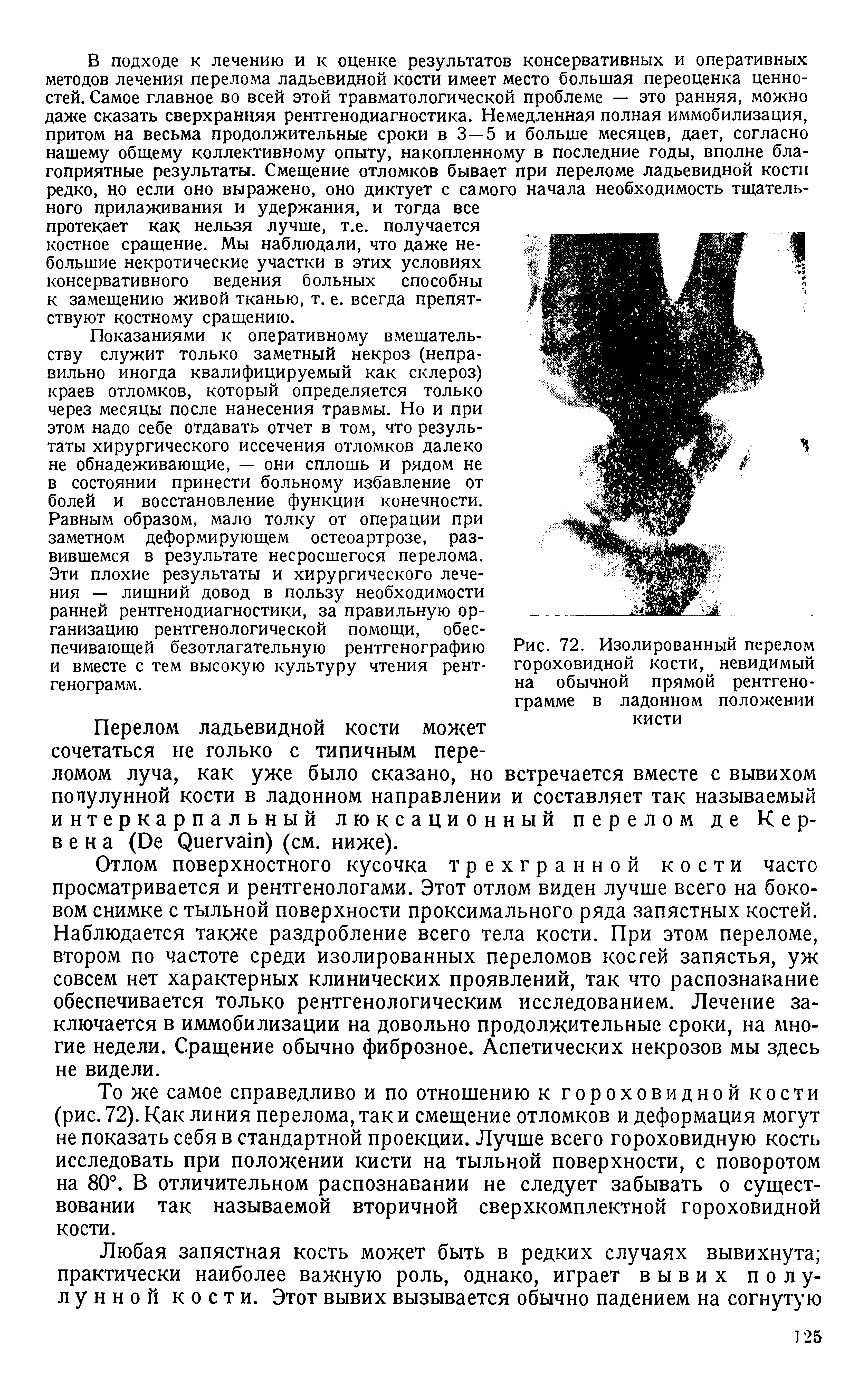 Рис. 72. Изолированный перелом гороховидной кости, невидимый на обычной прямой рентгенограмме в ладонном положении кисти...