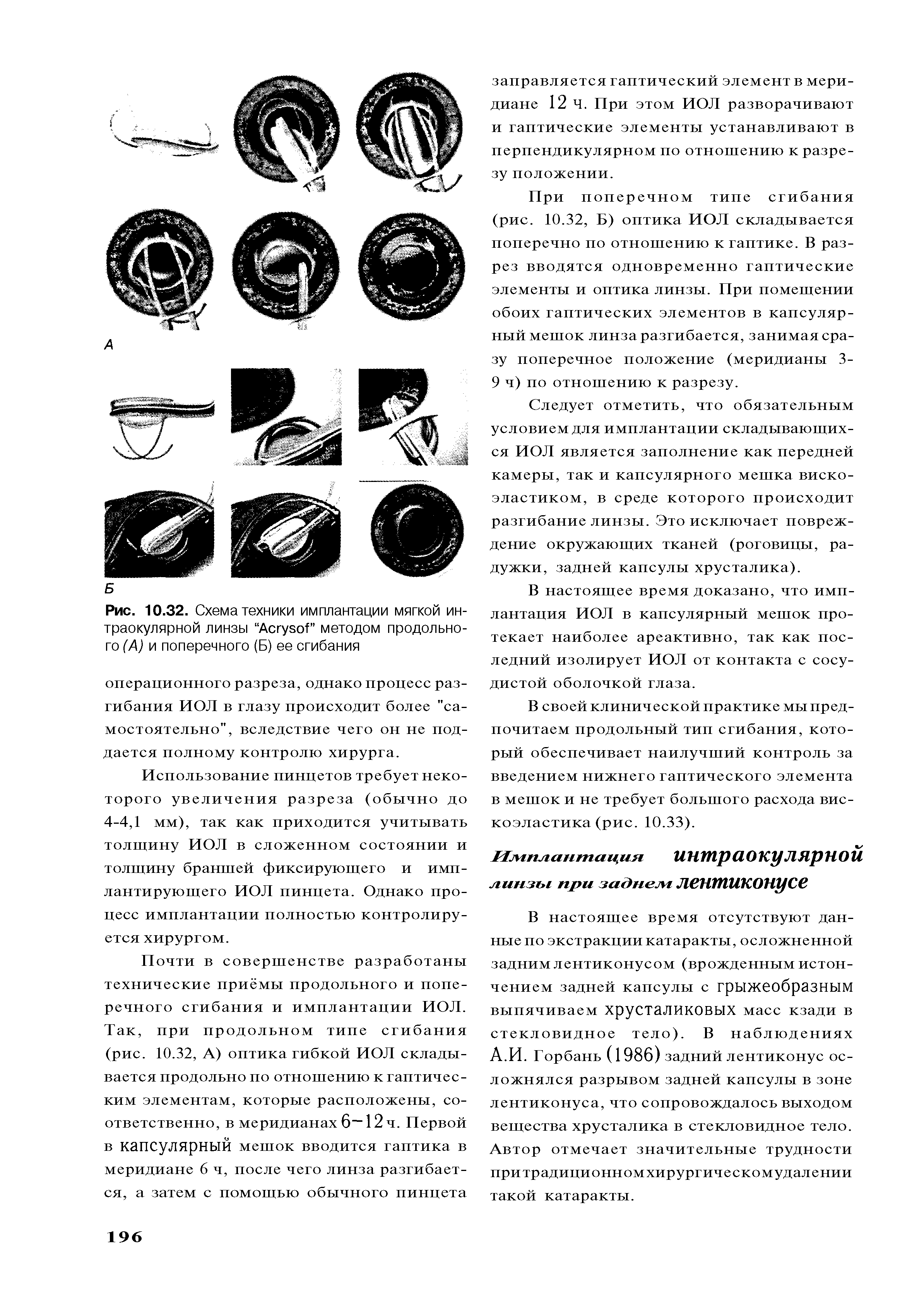 Рис. 10.32. Схема техники имплантации мягкой интраокулярной линзы АсгузоГ методом продольного (А) и поперечного (Б) ее сгибания...