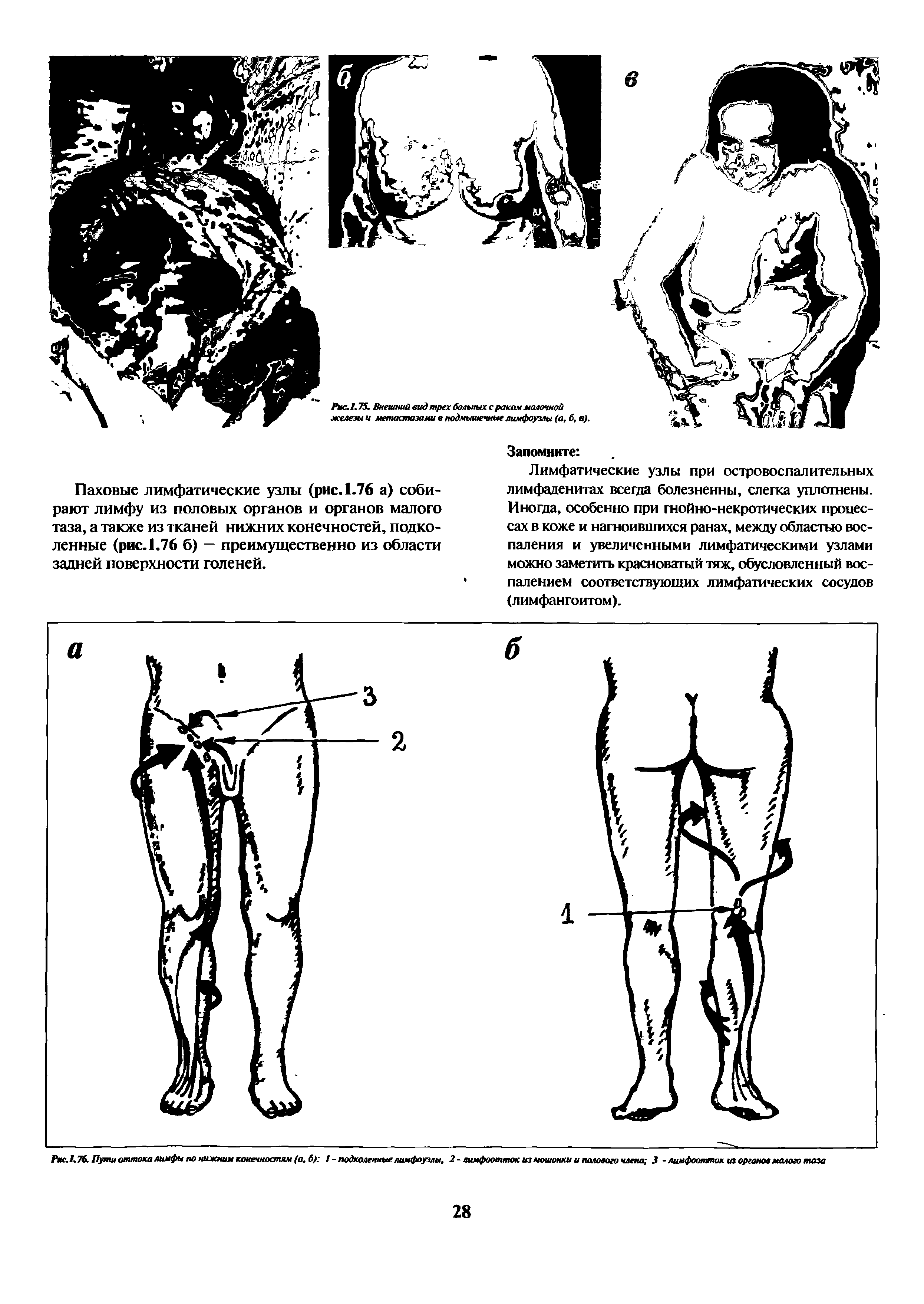 Рис.1,76. Пути оттока лимфы по нижним конечностям (а, б) 1 - подколенные лимфоузлы, 2-лимфоотток из мошонки и полового члена 3 - лимфоопапок из органов малого таза...