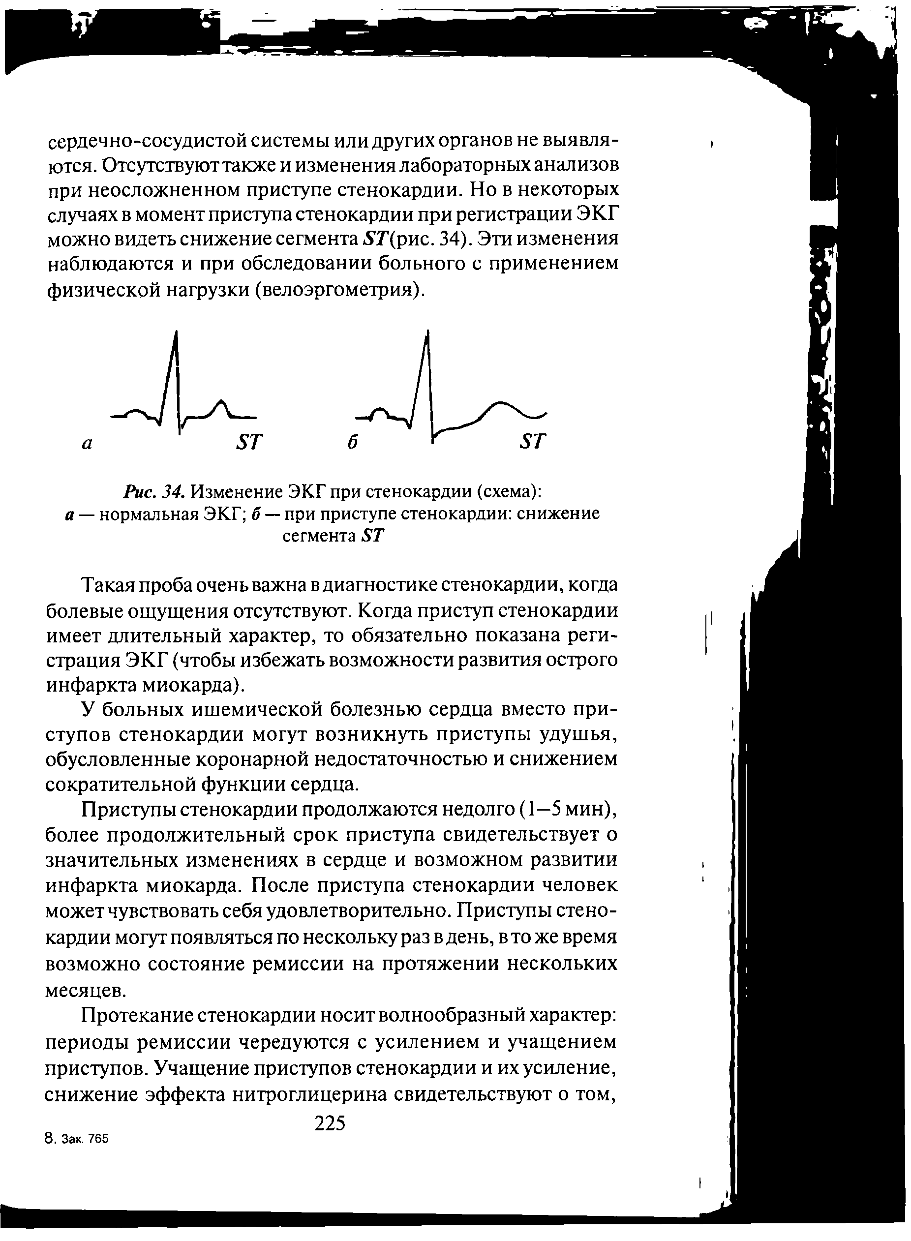 Рис. 34. Изменение ЭКГ при стенокардии (схема) а — нормальная ЭКГ б — при приступе стенокардии снижение сегмента 5Т...