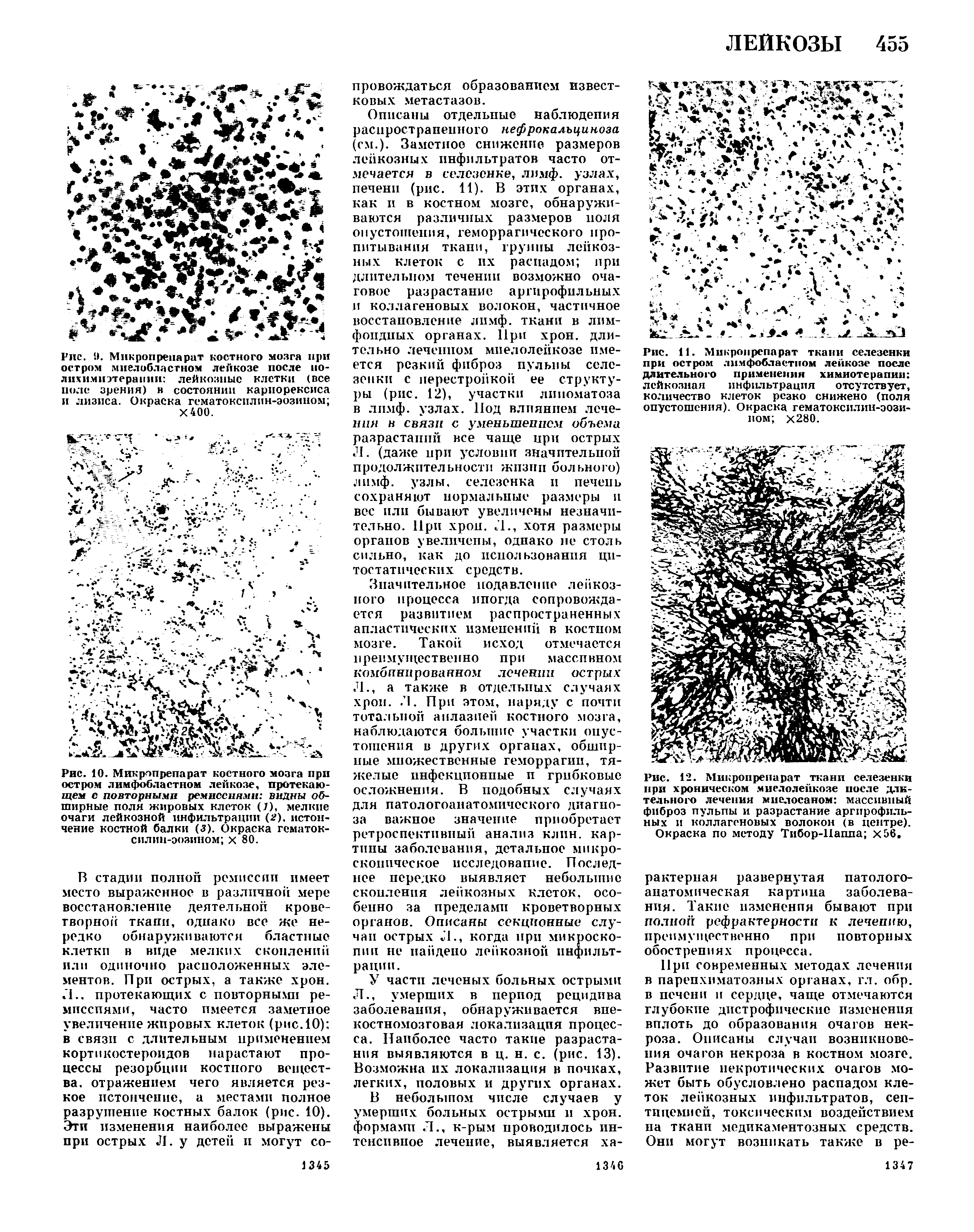 Рис. 12. Микропрепарат ткани селезенки при хроническом миелолейкозе после длительного лечения ми ел ос а ном массивный фиброз пульпы и разрастание аргирофильных и коллагеновых волокон (в центре). Окраска по методу Тибор-Иаппа Х56.