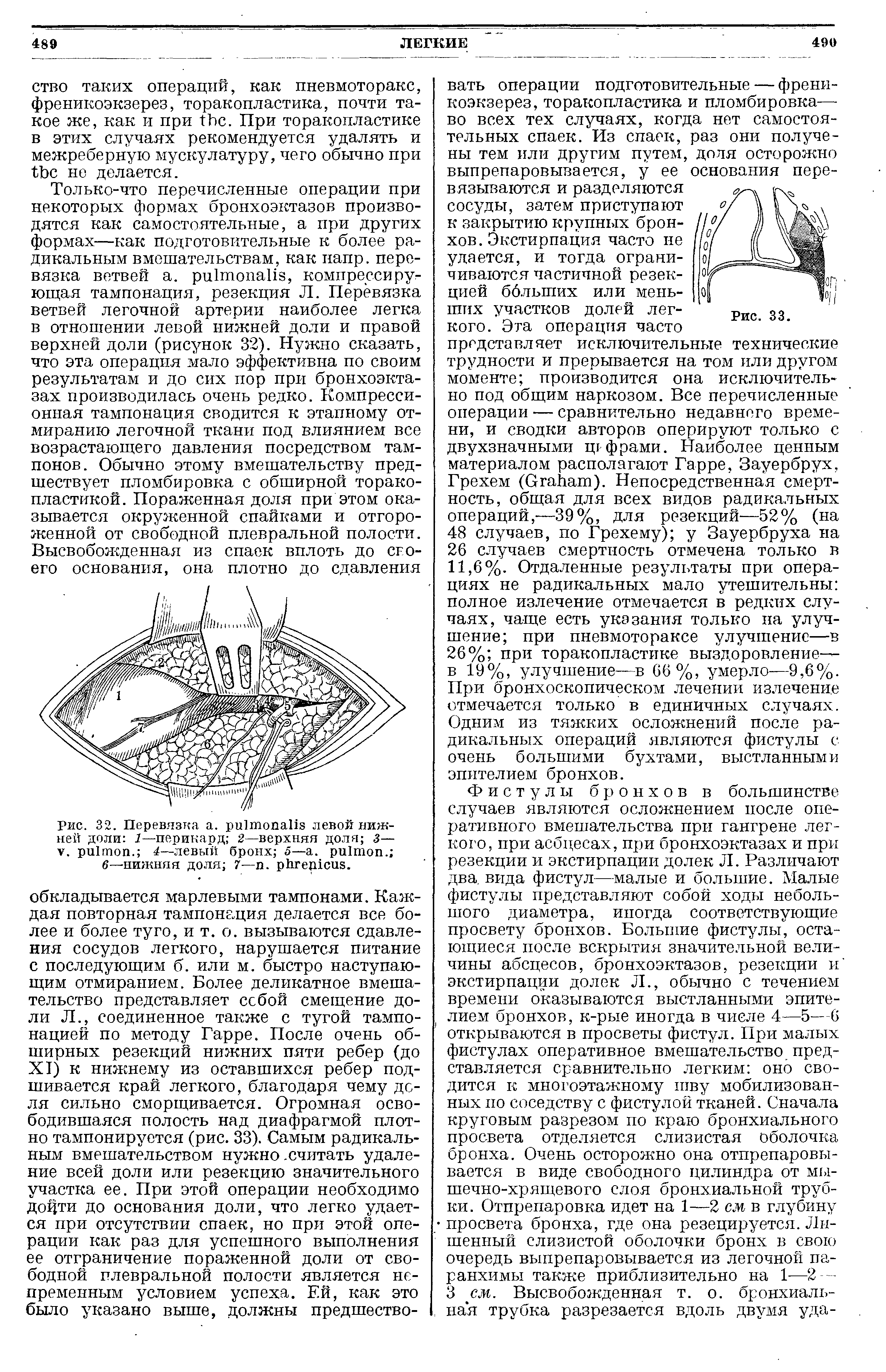 Рис. 32. Перевязка . левой нижней доли 1—перикард 2—верхняя доля 3— . . 4—левый бронх 5— . . ...