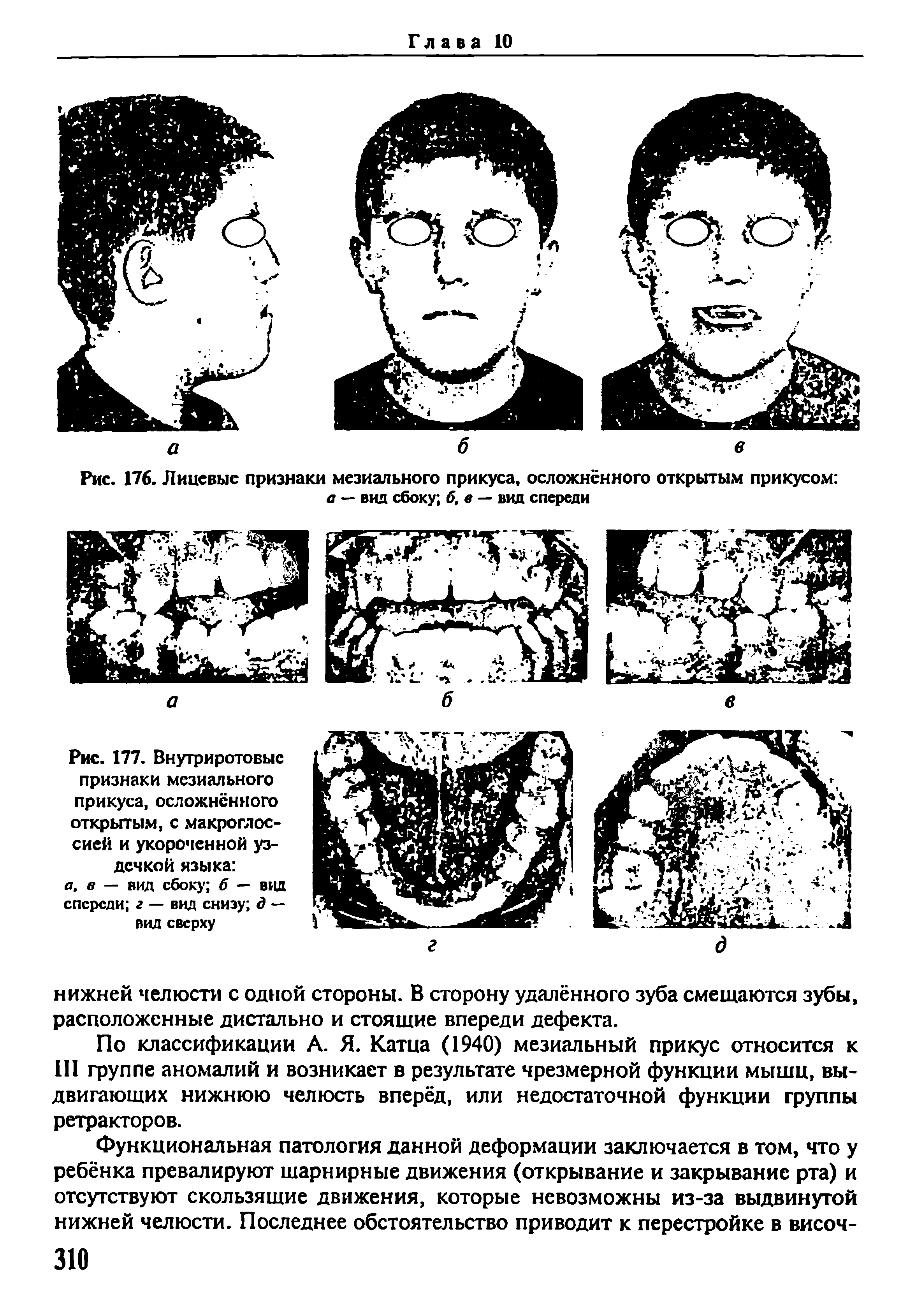 Рис. 177. Внутриротовыс признаки мезиального прикуса, осложненного открытым, с макроглос-сией и укороченной уздечкой языка ...