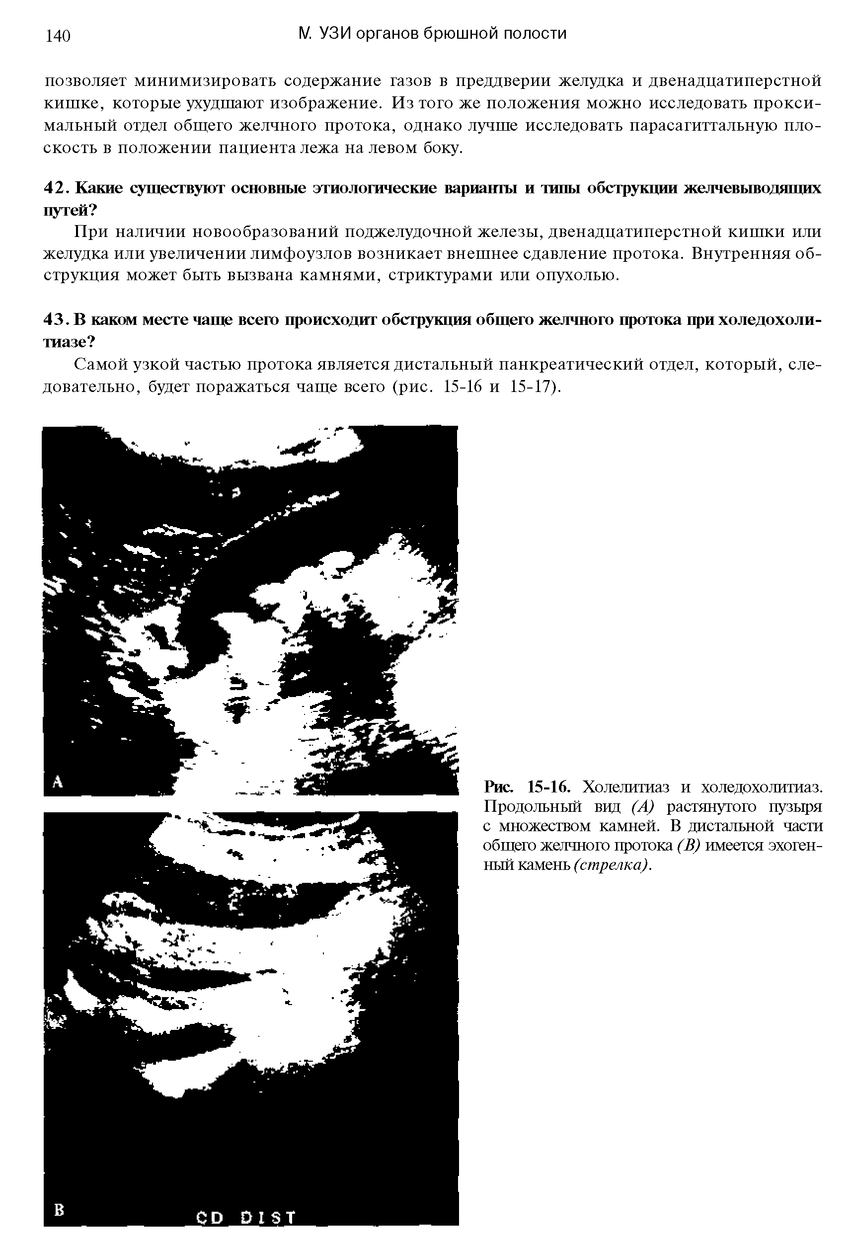 Рис. 15-16. Холелитиаз и холедохолитиаз. Продольный вид (А) растянутого пузыря с множеством камней. В дистальной части общего желчного протока (В) имеется эхогенный камень (стрелка).