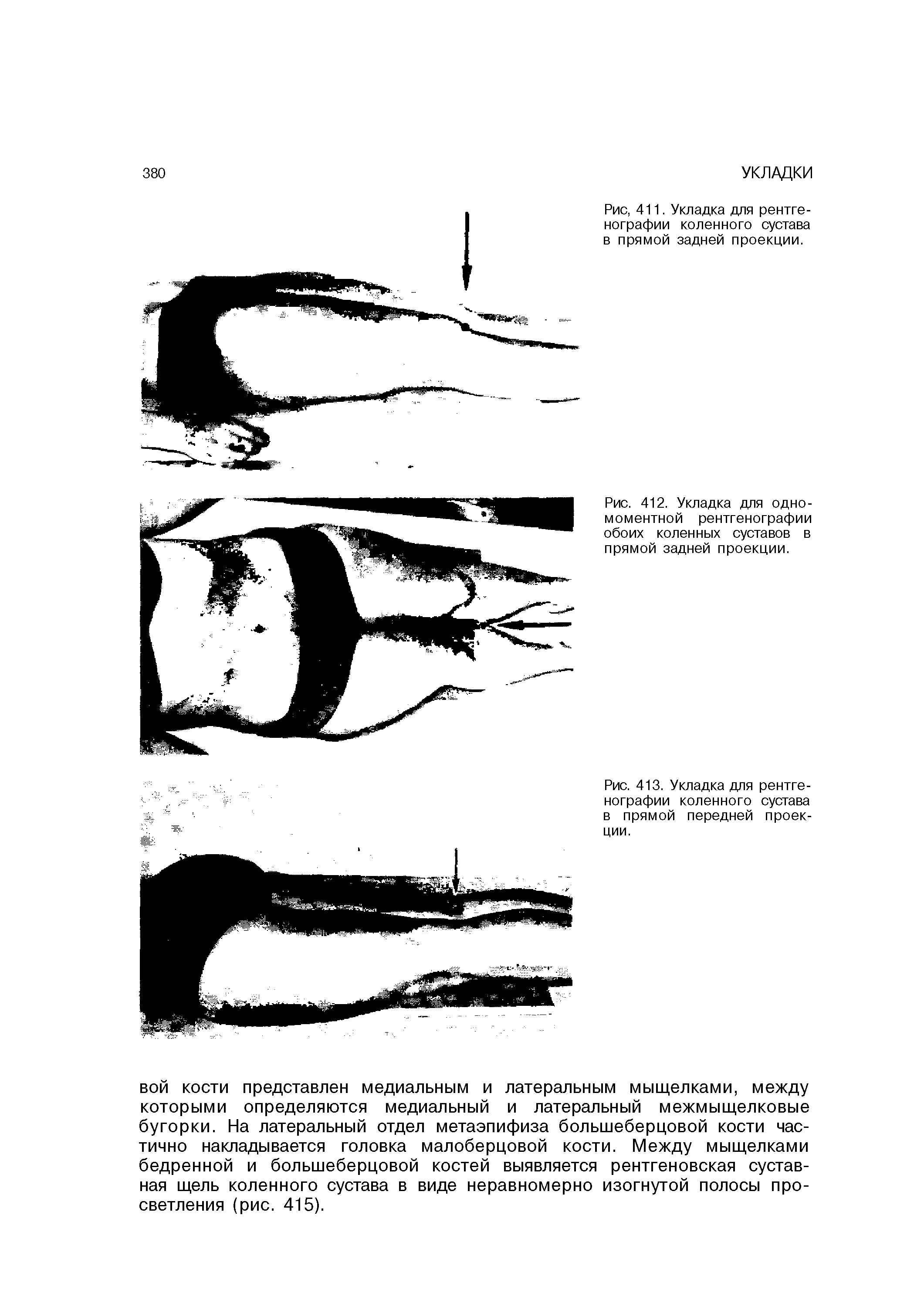 Рис. 412. Укладка для одномоментной рентгенографии обоих коленных суставов в прямой задней проекции.