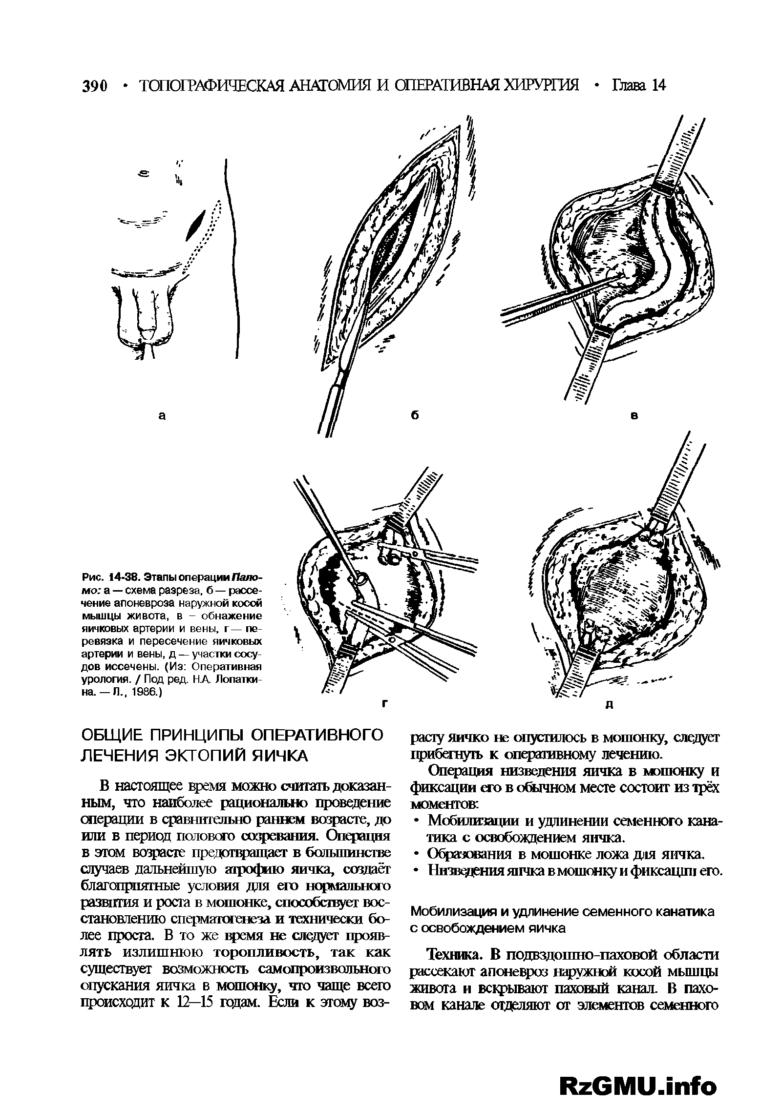 Рис. 14-38. Этапы операции Паломо. а — схема разреза, б — рассечение апоневроза наружной косой мышцы живота, в - обнажение яичковых артерии и вены, г— перевязка и пересечение яичковых артерии и вены, д — участки сосудов иссечены. (Из Оперативная урология. / Под ред. НА Лопаткина.—Л., 1986.)...