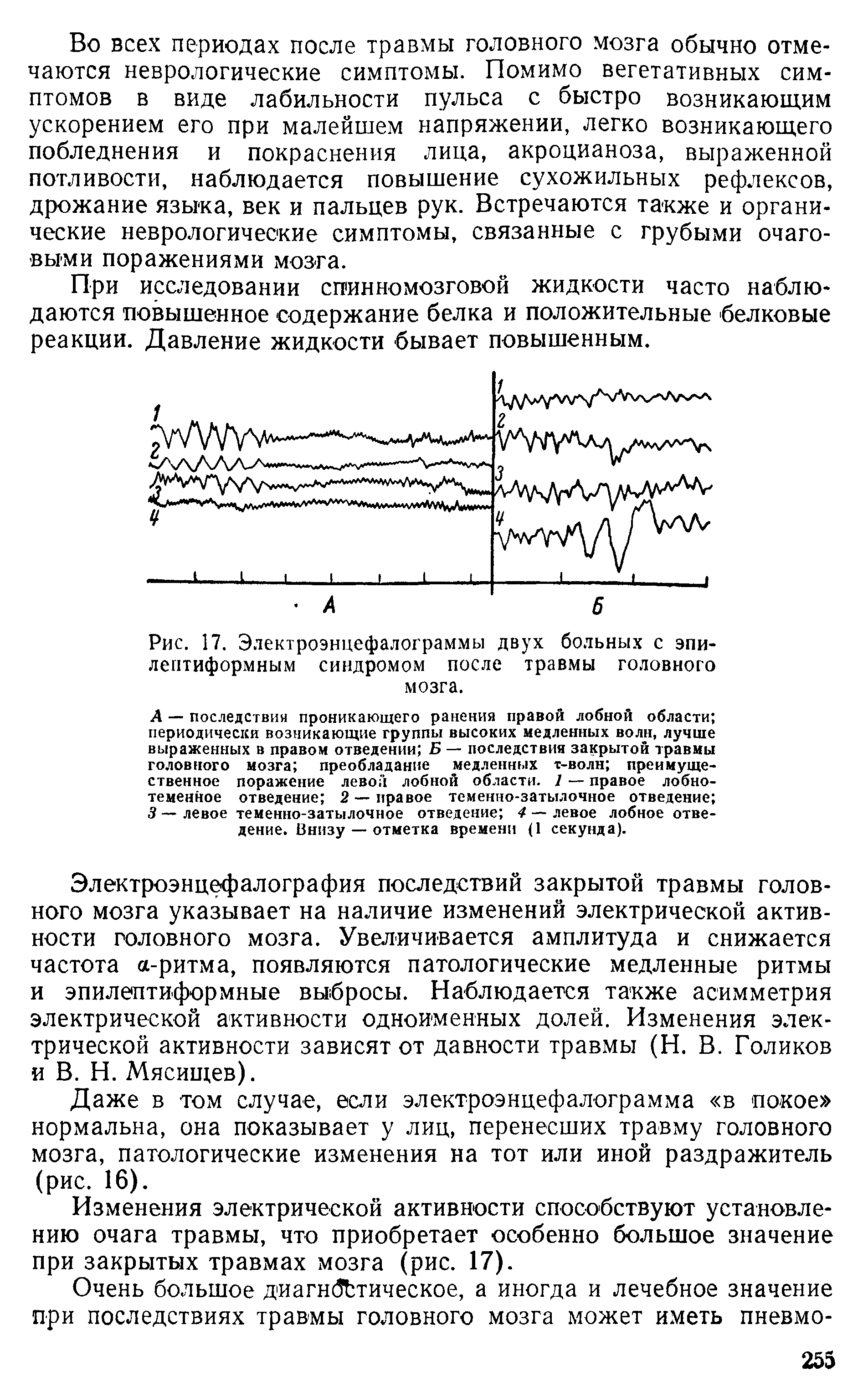 Рис. 17. Электроэнцефалограммы двух больных с эпилептиформным синдромом после травмы головного мозга.