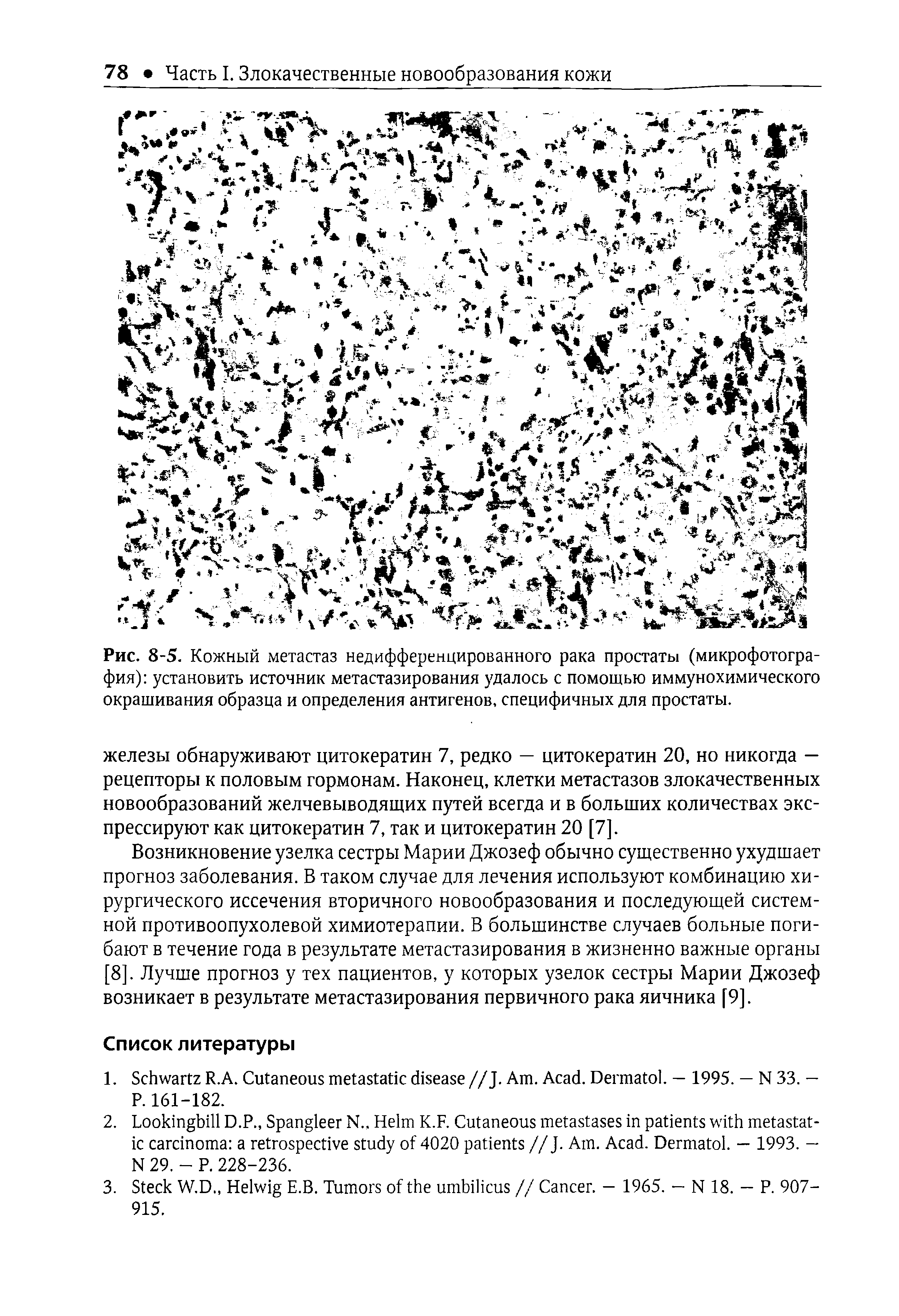 Рис. 8-5. Кожный метастаз недифференцированного рака простаты (микрофотография) установить источник метастазирования удалось с помощью иммунохимического окрашивания образца и определения антигенов, специфичных для простаты.