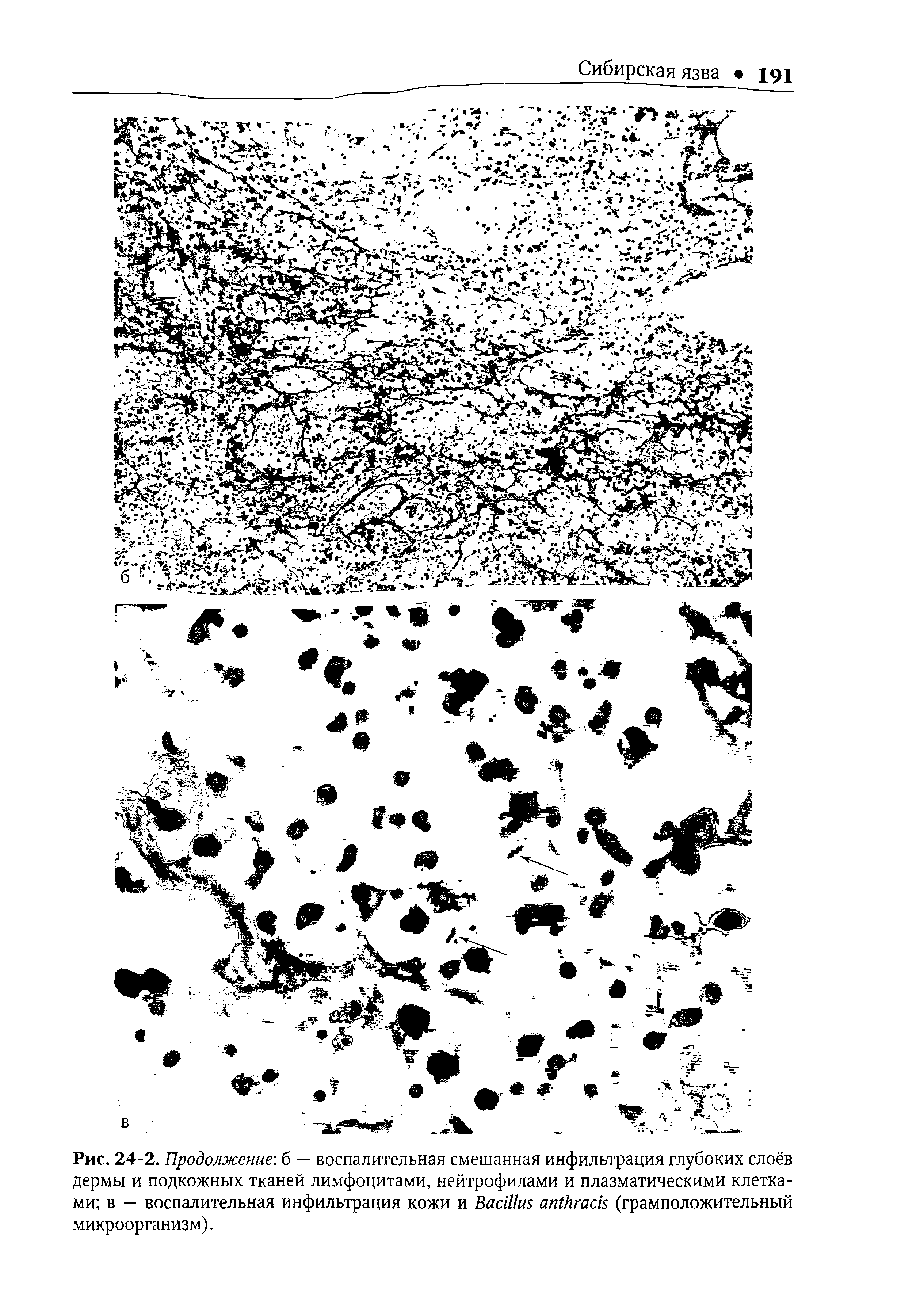 Рис. 24-2. Продолжение, б — воспалительная смешанная инфильтрация глубоких слоёв дермы и подкожных тканей лимфоцитами, нейтрофилами и плазматическими клетками в — воспалительная инфильтрация кожи и B (грамположительный микроорганизм).