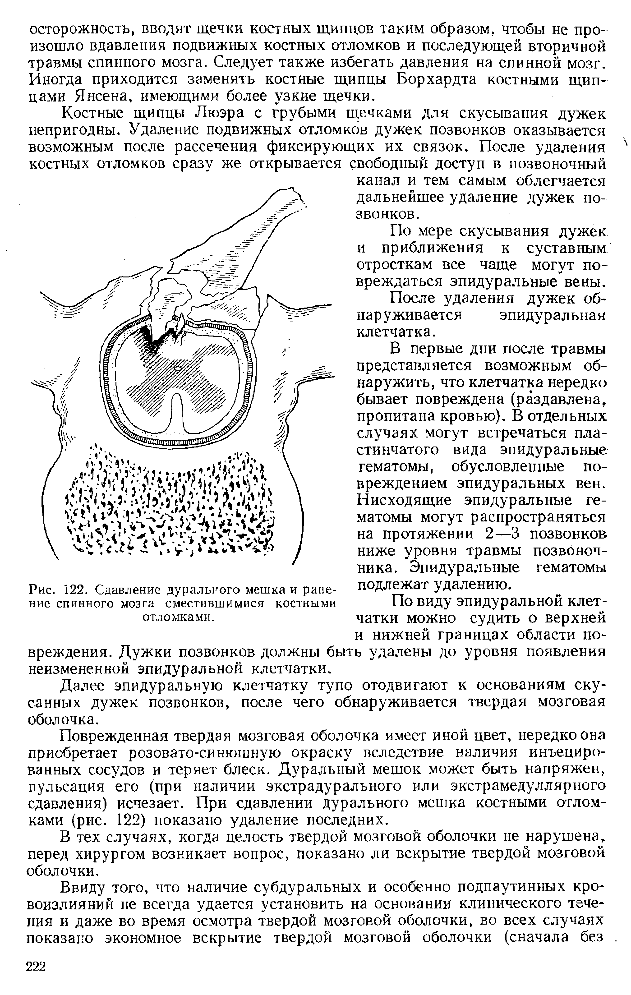 Рис. 122. Сдавление дурального мешка и ранение спинного мозга сместившимися костными отломками.